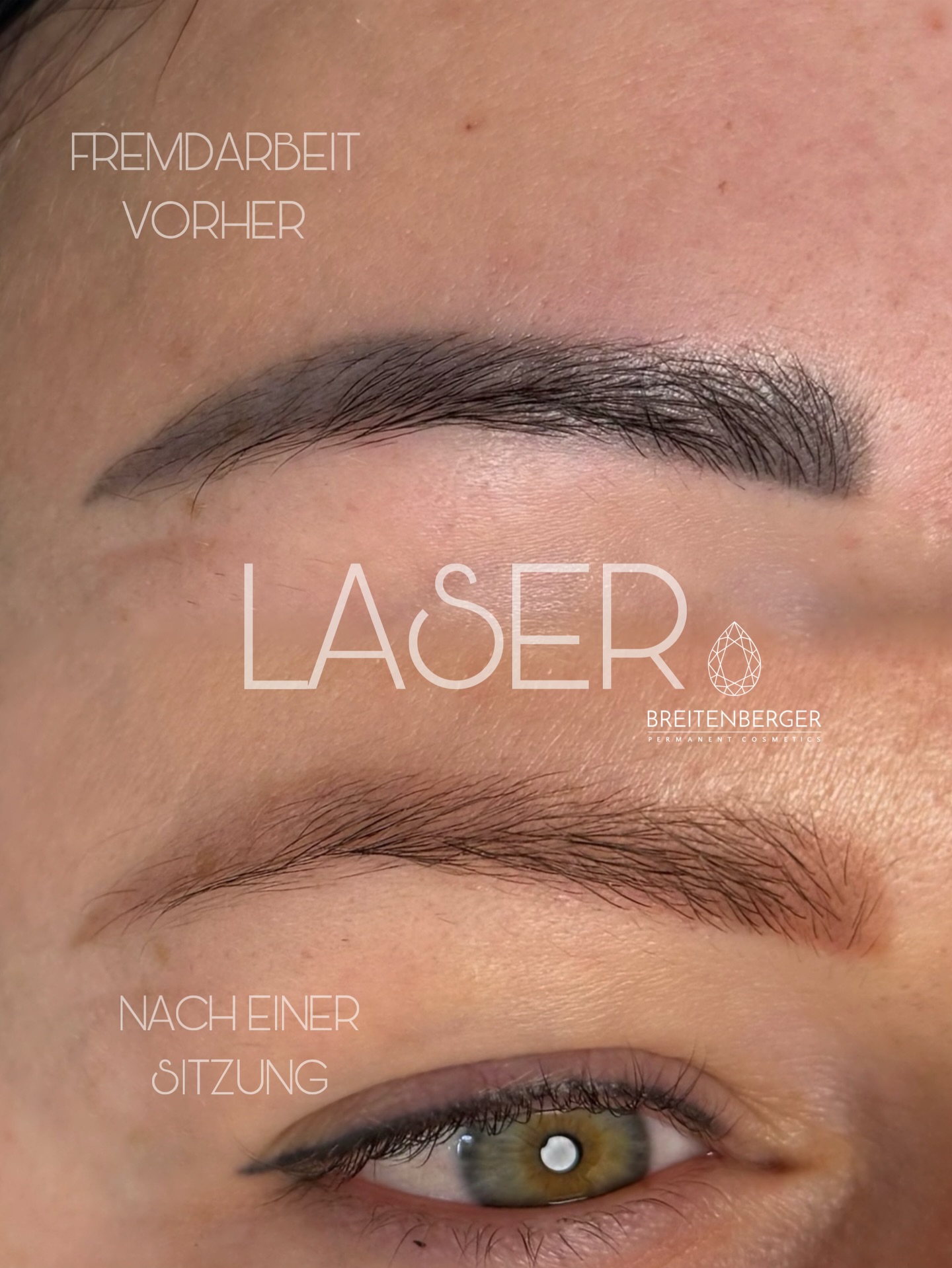 Dein Permanent Make Up ist grau geworden?
Kein Problem - so können deine Augenbrauen bereits nach einer Laser Sitzung aussehen. Mit so gut wie keiner Ausfallzeit. Du darfst die Augenbrauen nach 24 Stunden bereits wieder nachzeichnen, wenn du es möchtest. Die Haut bleibt bei richtiger Anwendung intakt - dh. keine Wunde, Kruste, Blasen… Lediglich kurze Rötung und Schwellung, die idR. nach ein paar Stunden wieder verfliegt.
Im zweiten Slide siehst du die Behandlung in Echtzeit. Das Lasern der Augenbrauen dauert keine 5 Minuten, und das Ergebnis ist super effektiv, wie man auf dem Nachher Foto erkennen kann.
Das ist übrigens einen Monat nach dem Lasern entstanden, vor der zweiten Sitzung. Bei der zweiten Sitzung haben wir den warmen, rötlichen Rückstand entfernt. Beim nächsten Termin können wir wieder frisch starten 😍
PMU ENTFERNUNG
PMU REMOVAL
LASERREMOVAL
PICOLASER