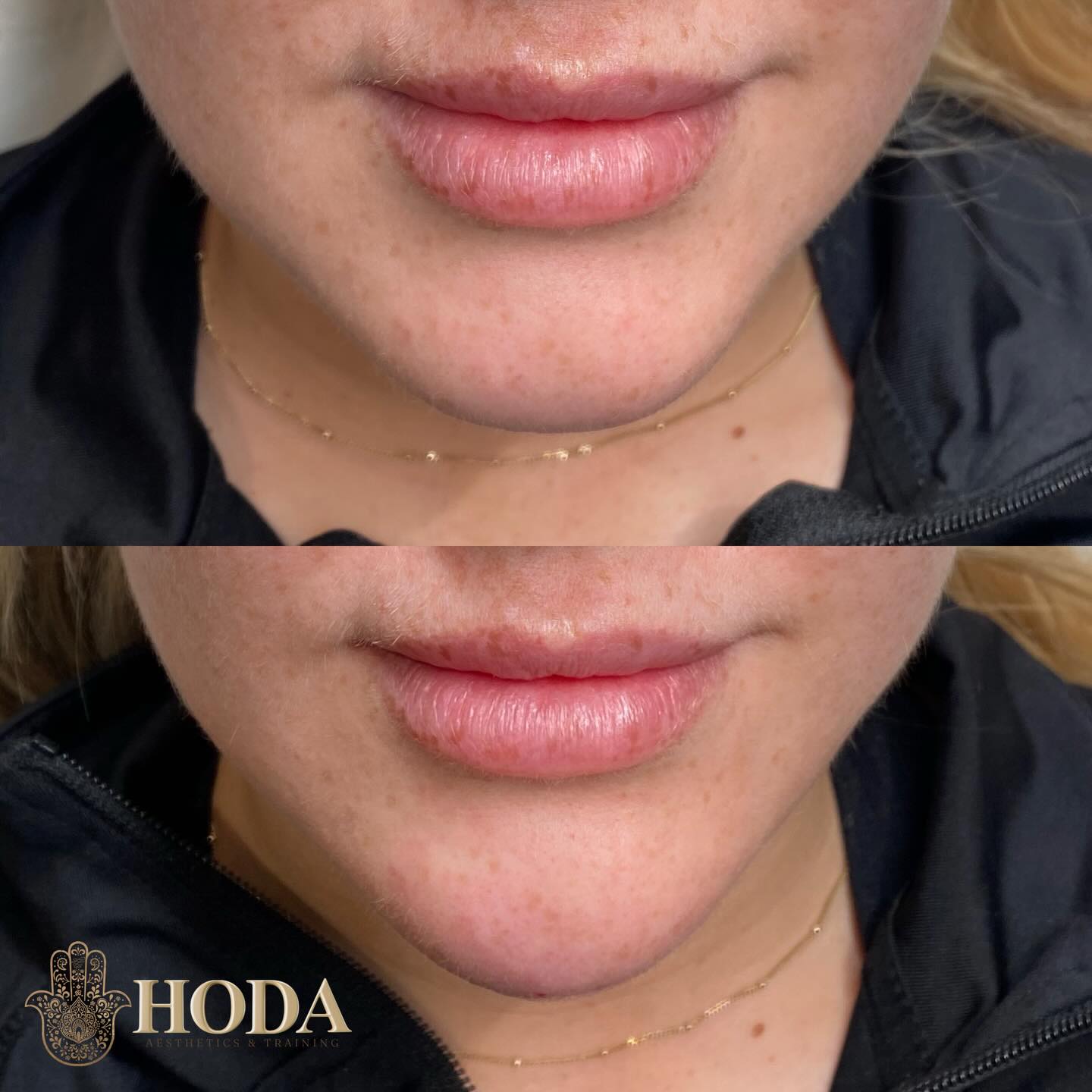 โจ Chin Filler Transformation โจ
Subtle changes can make a powerful difference ๐ค
This client had chin filler to enhance projection, improve profile balance, and create a smoother, more defined lower face.
The result?
โ๏ธ Improved chin structure
โ๏ธ Better facial harmony
โ๏ธ Natural, soft enhancement โ never overdone
Before & After shown
As always, results are tailored to the individual and designed to enhance natural beauty โจ
๐ฒ DM book with Hoda
๐ฉ๐ผโโ๏ธ Nurse Led-Aesthetic Clinic
๐ Bournemouth, Dorset
#ChinFillerBournemouth #BournemouthAesthetics #BournemouthClinic
#AestheticsBournemouth #DorsetAesthetics UKAesthetics