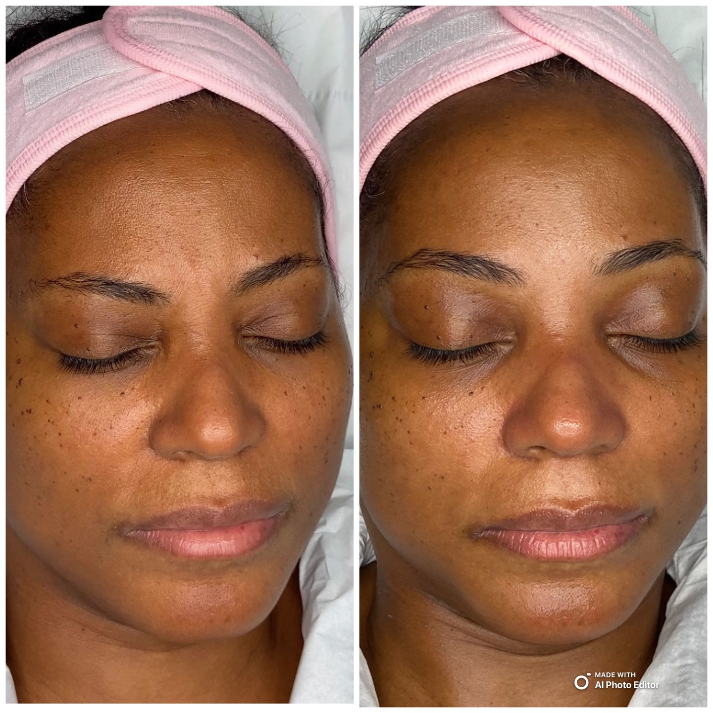 See the glow. Feel the confidence.
Wondering what a real transformation looks like? flawless skin and defined brows can change not just your look, but your whole mood. This is more than a treatment. It’s a confidence boost you can see and feel.
Every result is personal, every glow is unique. At Beauty by Naz, I use advanced techniques to deliver results that speak for themselves. No filters. No exaggeration. Just real women, real change.
Ready to discover your own before & after? Book your consultation with Naz today. ✨
Your skin. Your story. Your time to shine. 💖