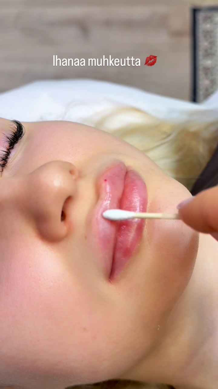 Huulten muotoilu on suosittu hoito vuodesta toiseen. Toiset tykkäävät muhkeammista - toiset luonnollisista. Molemmat ovat mahdollisia toteuttaa.