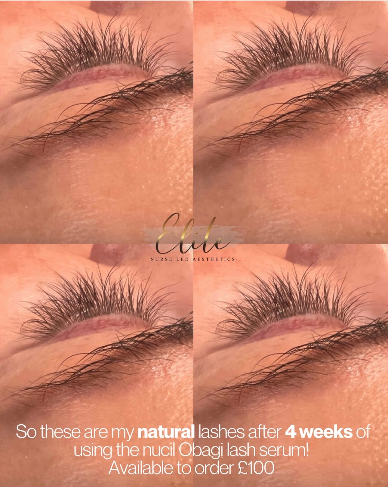 My Natural Lashes After 4 Weeks Using Obagi Nu-Cil! 🌟
Can you believe these are my natural lashes? 😍
After 4 weeks of using the Obagi Nu-Cil Lash Serum, my lashes are longer, thicker, and healthier than ever — and that’s after I used to have eyelash extensions! ✨
💫 This serum really works — no extensions, no falsies, just naturally fuller lashes!
💷 Available to order now – £100
📞 DM to order yours or message to find out more!
📍 Elite LED Nurse Aesthetics, Wakefield
#EliteLEDNurseAesthetics #WakefieldAesthetics #ObagiNuCil #LashGrowthSerum #NaturalLashes