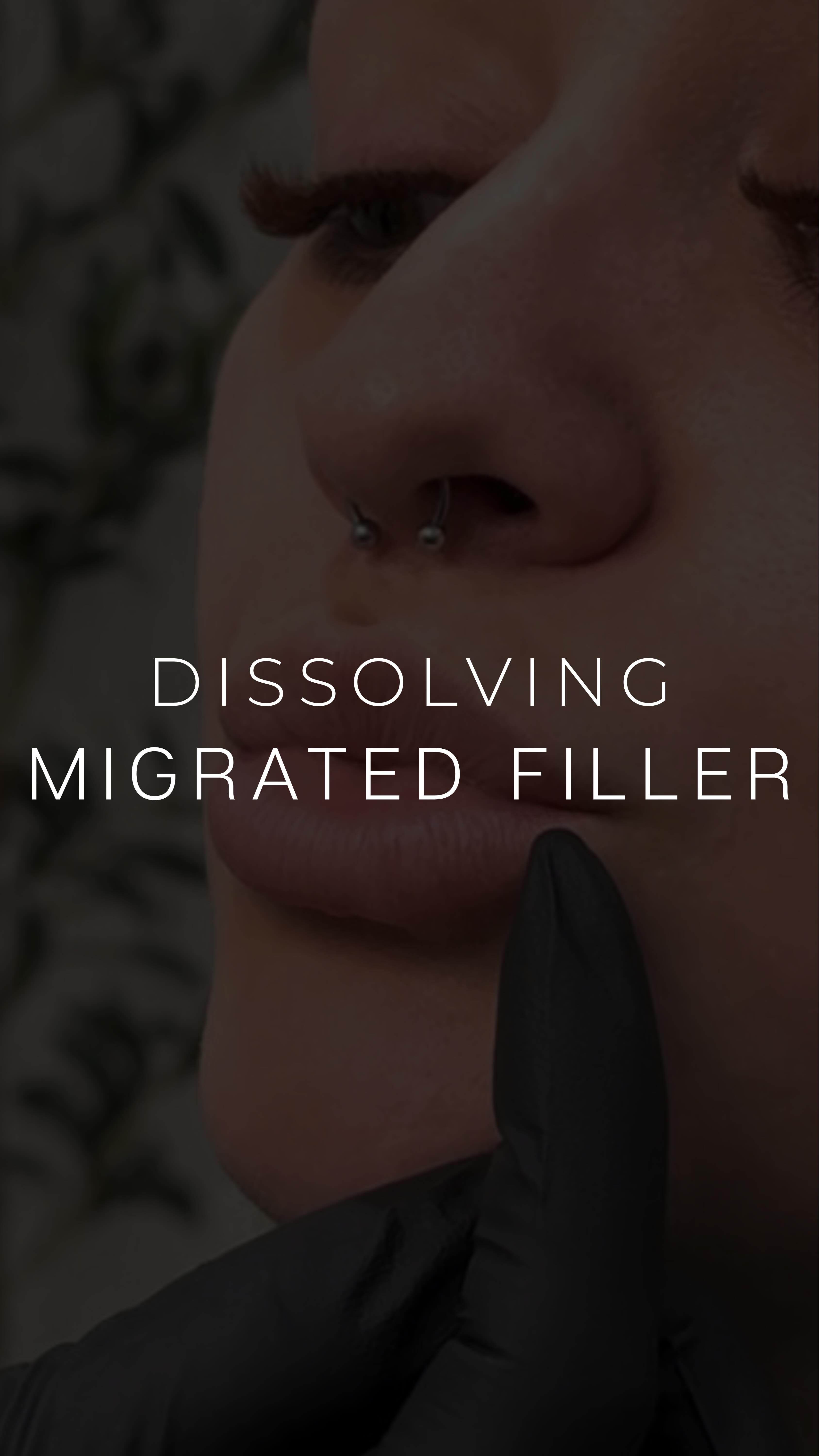 Dissolving filler can feel intimidating, but we’re here to guide you through every step!🤗
It’s important to follow your provider’s recommendations when dissolving migrated filler—especially before refilling an area like the lips. Most patients are advised to wait 2–4 weeks before refilling, depending on your individual plan.
During a lip dissolving treatment using Hylenex, we perform a dental block beforehand to keep you comfortable throughout the process. Swelling and possible bruising are normal. Once the Hylenex is injected, your provider will gently massage the area to ensure it spreads properly and breaks down the filler as intended. Around 48 hours later, swelling typically settles, allowing you to see your dissolving results.
Some patients may require multiple dissolving sessions, depending on the type of filler used and the extent of migration. The number of vials needed can also vary and will always be discussed with you during your appointment so you know exactly what to expect.
Think you might have filler that needs to be dissolved? Schedule a consultation with us! ✨☺️
