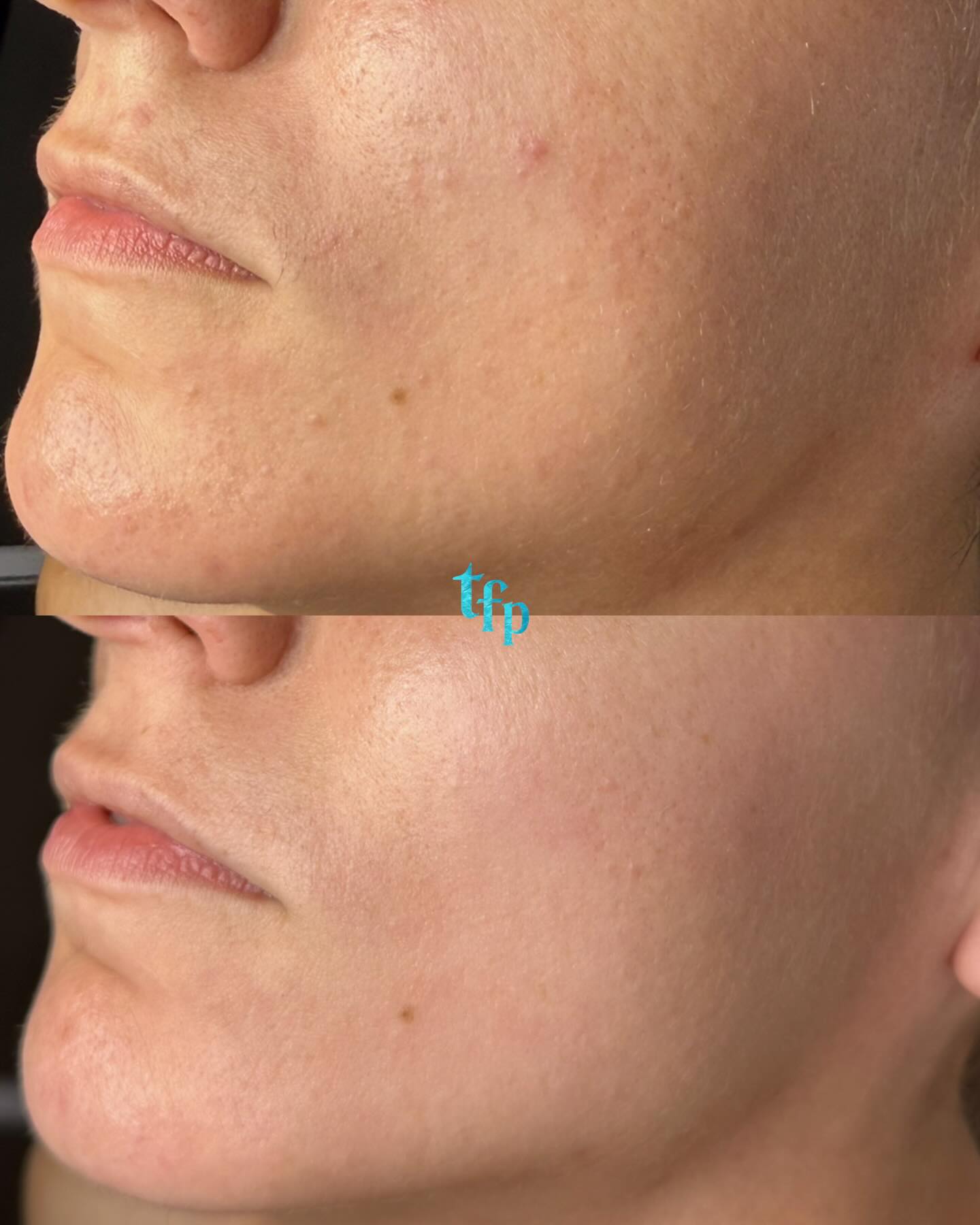 It’s okay to want to clear your acne even if you don’t have SEVERE acne. 🫶🏼 texture can be bothersome. But Acne Bootcamp will help!
🩵This client did 3 months of bootcamp and her bumpy texture and fine lines did a 180! We focused on hydration and chemical peels and her skin is so smooth now!
You can book an Acne Facial with me for this month and we can also discuss if Acne Bootcamp is right for you.
Book on thefaceplacemi.com
See before and afters on thefaceplacemi.com
And read about how acne bootcamp works on thefaceplacemi.com under “bootcamp” or read my pinned instagram post!🪩🪼