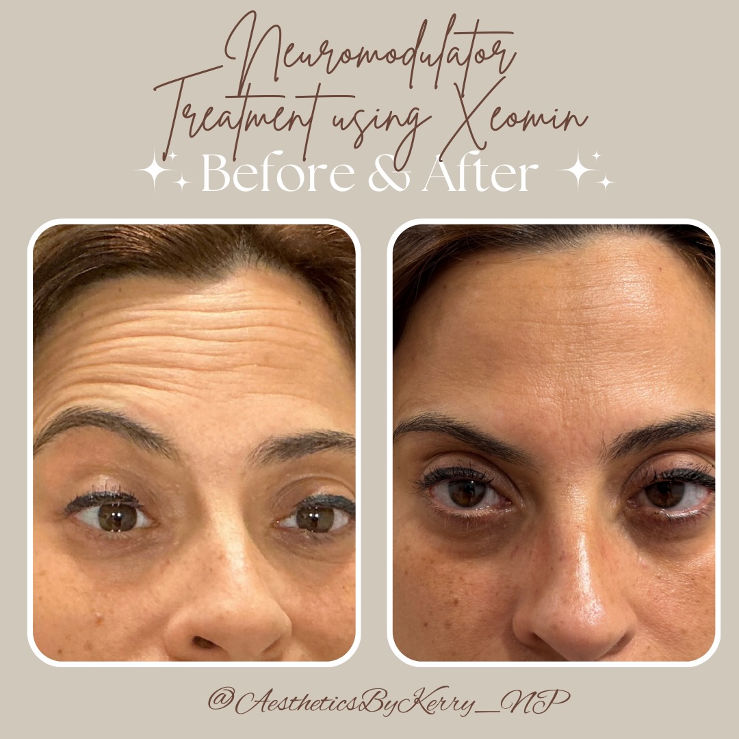 Facial asymmetry is more common than you think.
From uneven brows to one side of the face moving more than the other, subtle imbalances can affect your expressions over time.
✨ Botox treatments can help soften muscle dominance, improve facial symmetry, and create more balanced, natural-looking expressions—without freezing your face.
As an aesthetic nurse practitioner, I customize every Botox treatment to your unique facial anatomy for results that look refreshed, not overdone.
📲 Book your personalized Botox consultation today. Link in bio. ✨ #southfloridainjector