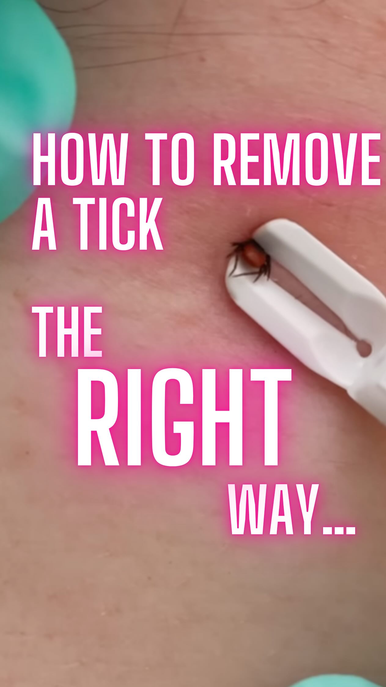 Here’s how:
1. Blunt nose tweezers - grasp as close to the skin as possible and pull straight out
2. If using a tick removal tool follow the instructions - some of these require a cheeky twist
3. For extra points clean the skin with soap/water / alcohol gel afterwards.
4. Dispose of the little b*****d properly so it can’t come back for more!
5. Safety net: seek medical advice if new headache/fever/malaise or bullseye rash around the bite site (may indicate Lyme disease)
6. There’s no need for routine Lyme disease testing or antibiotics on the basis of a tick bite alone.
#wildernessmedicine #expedition #remotemedicine #paramedic #doctor