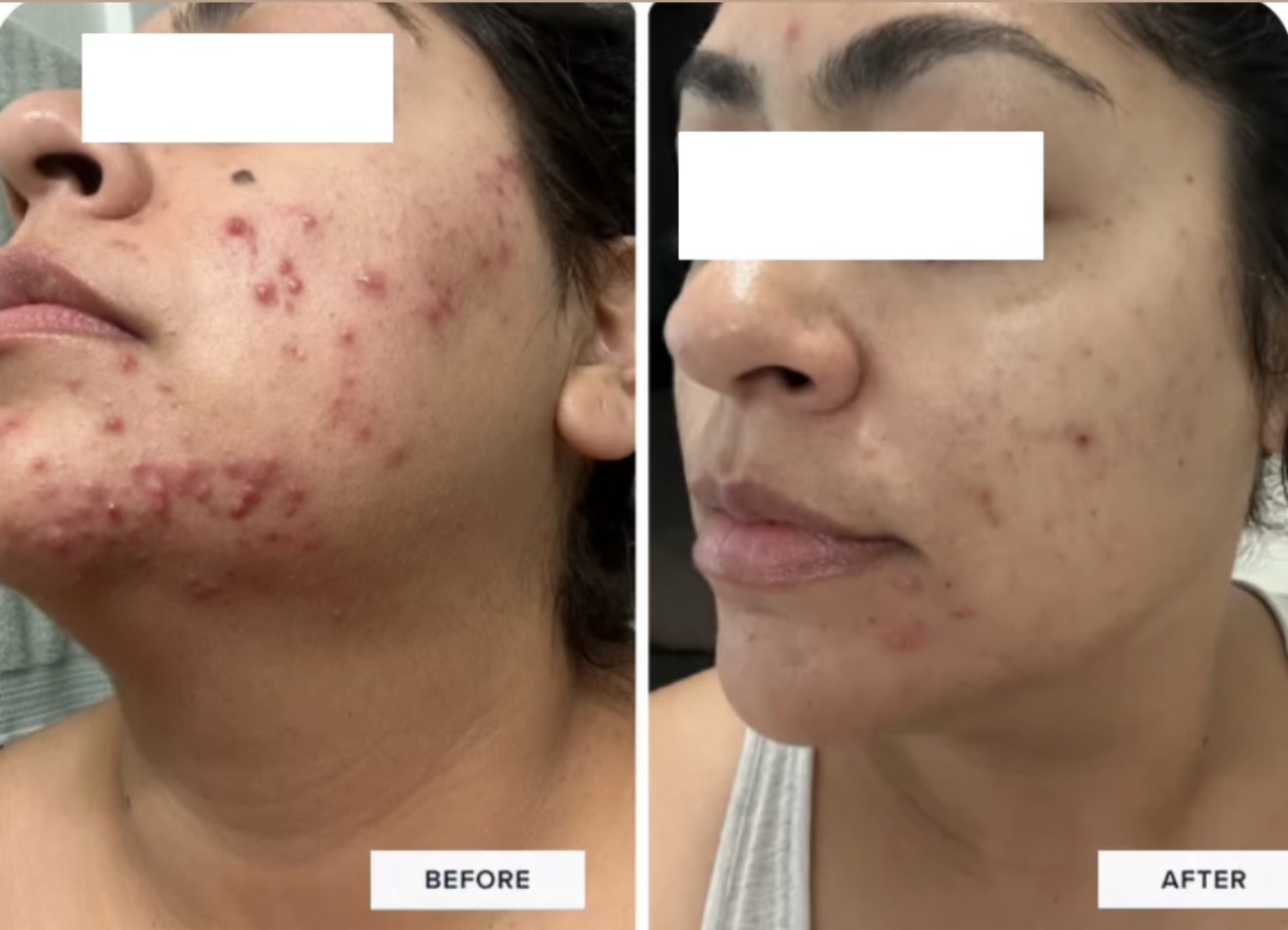 This client came in with active breakouts, inflammation, and post-acne redness mainly around the lower face. After just 4 BioRePeel treatments, her skin is visibly calmer with fewer active lesions, reduced redness, and smoother texture. BioRePeel works by stimulating cellular turnover and clearing congestion without aggressive downtime, making it ideal for acne-prone and sensitive skin types.
Consistent treatments + proper homecare = real transformation.
Acne takes time, patience, and the right approach — but it IS treatable.
Now we’re continuing to work on pigmentation and texture while keeping inflammation controlled.
📍Non-invasive
📍Minimal downtime
📍Safe for most skin types
📍Targets acne, congestion, texture & discoloration
#acnetreatment #biorepeel #acneprone #acnejourney #chemicalpeel skintransformation beforeandafter skincareclinic skincareprofessional skincareroutine acnecare postacnemarks pigmentation skincaretips estheticianlife dermaglow acnesupport minimaldowntime healthyglow skincarecommunity skinresults confidenceinskin realresults facialtreatments textureimprovement beautyclinic hyperpigmentation acnehelp