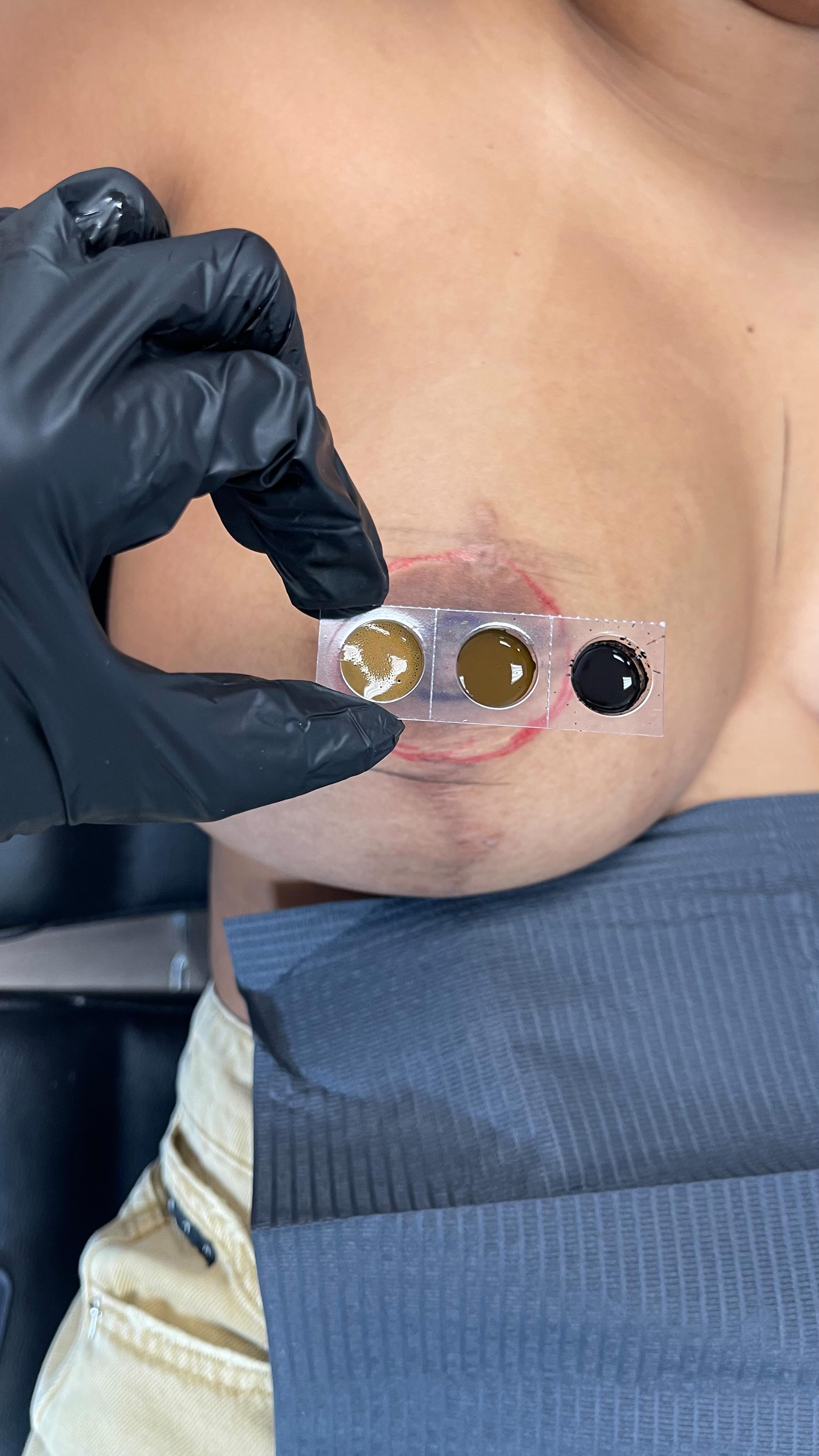 To Be Continued…
Stay tuned for healed results upon first session of Areola Repigmentation and the journey of medical camouflaging to lighten her anchor scars.
Follow us for more @beatandblade
#areolatattoo #breastaugmentation #scarcamouflage #scars