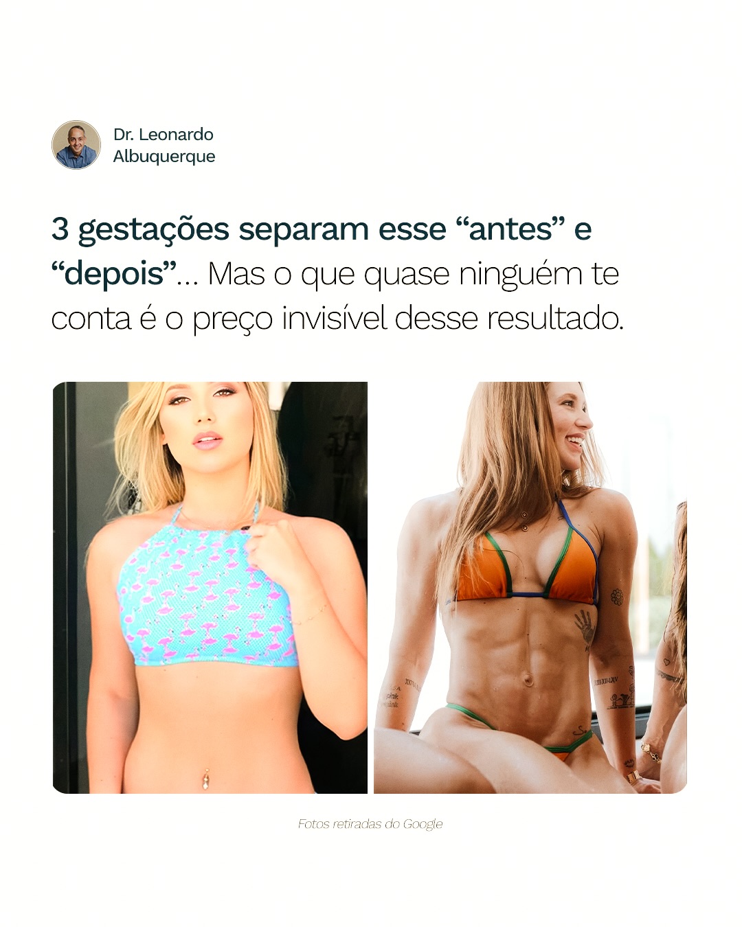 Nem tudo que parece “resultado incrível” nas redes sociais é sinônimo de saúde ou boa medicina.
A cirurgia plástica ética não segue modismos, não promete milagres e não aceita riscos desnecessários em troca de aparência.
Cada corpo tem limites.
Cada história exige responsabilidade.
📲 Clique no link da bio e descubra seu corpo ideal.
Dr Leonardo Albuquerque | Cirurgia Plástica
Formado pela USP e membro da SBCP
CRMBA 23068 | RQE 10486
📍Ilhéus - Bahia
.
.
.
#plastica #Virginia #DrLeonardoAlbuquerque