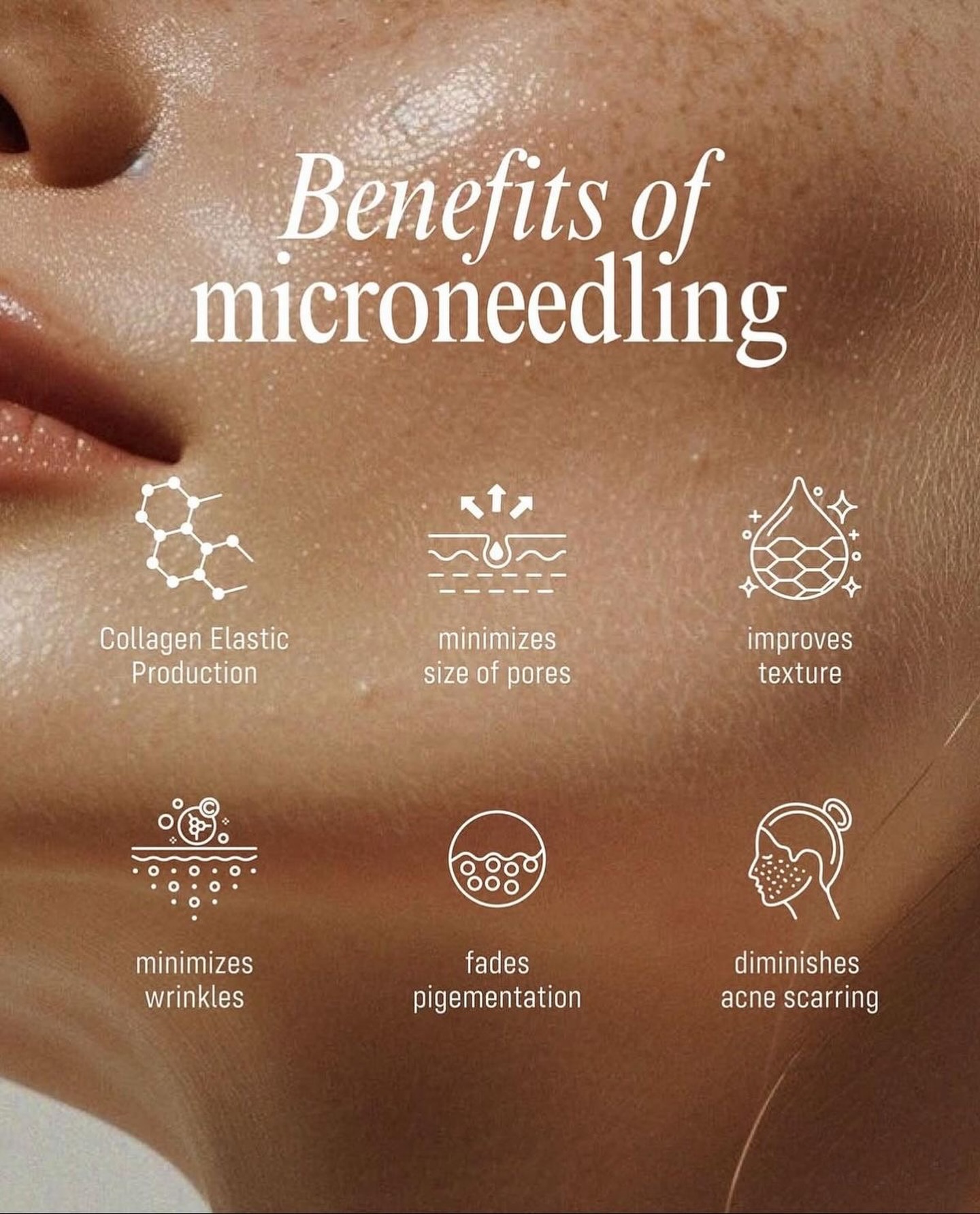 Microneedling that works with your skin ✨
A course of three microneedling sessions helps activate your skin’s natural repair process, boosting collagen production by up to 400%.
The result? Smoother texture, firmer skin, and a glow that builds long after your appointment 🤍
Book your consultation and start your skin renewal journey.
#TheGlowBar LDN #microneedling #collagenboost #skinrenewal #advancedfacials