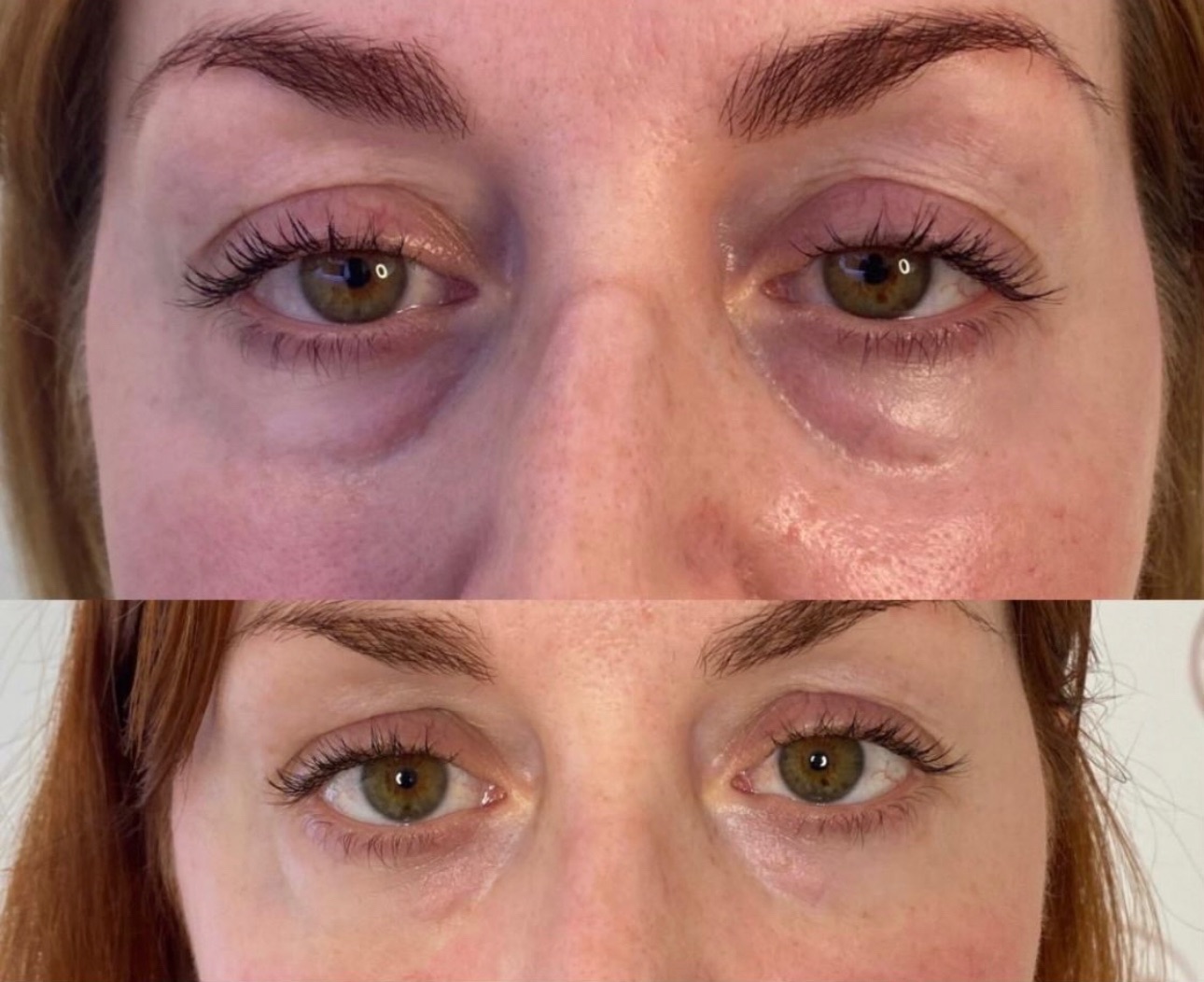 Struggling with puffy under-eyes that never seem to go away? ✨
These results speak for themselves 👀👇
Sunekos for the under-eyes works by stimulating collagen and elastin in the delicate eye area — improving skin quality from within, not just masking the problem.
What Sunekos can do:
✔️ Reduces puffiness and under-eye bags
✔️ Improves dark circles
✔️ Smooths fine lines and crepey skin
✔️ Boosts hydration and elasticity
✔️ Creates a fresher, brighter, well-rested look
✨ Look at these results — my client’s puffy under-eyes are completely gone, with a smoother, more refreshed appearance 🤍
💬 DM “SUNEKOS” to book a consultation or find out if this treatment is right for you.
📍 Wakefield
📍 Elite Nurse Led Aesthetics
#EliteNurseLedAesthetics #WakefieldAesthetics #SunekosUnderEyes #UnderEyeTreatment #NurseLedCare