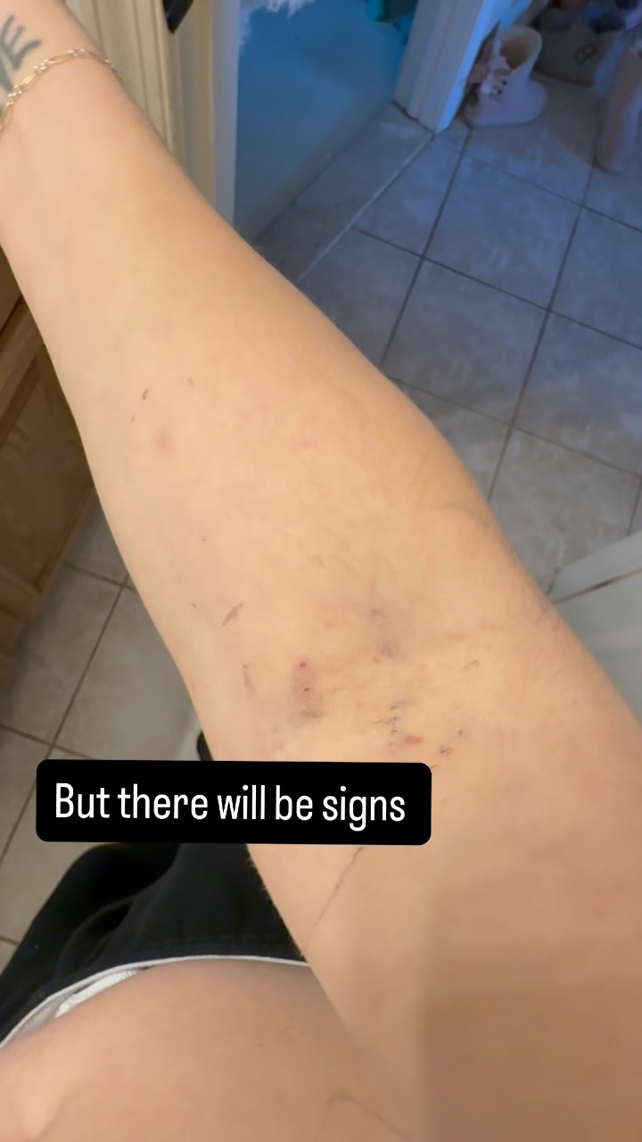 I share not for empathy, sympathy, or attention. I share because sooo many people have reached out lately and said “I am going through this too!” Or “I just got through such a similar stage, you can do it!” I’m here to tell you that life has not been easy, it’s always worth it. Your health, both physical and mental have to be your first priority or you will end up like me… I put myself on the back burner for far too long and now this is my second stint in the hospital this year. And when I tell you, sister, it’s not worth it.
This time around I spent 18 hours in the ER, then was admitted and got a room. But in that time I had an MRI, CatScan, chest xray, stomach xray, endoscopy, pelvic ultrasound, ekg, and when I tell you vials and vials of blood, I am not exaggerating. All to still have very little answers.
Except I know one of those answers, and that is the pure amount of stress I have been under this year is not for the faint of heart. And here’s my body saying, NO MORE.
If you feel like me, you’re not alone. Feel free to reach out if you ever need a hand to hold. Don’t let it get this far. It’s not worth it sister, your health has to come first or you’ll end up listening to others yack for 18 hours before you get your sticky sock vacation (and not the fun one).
Thank you for supporting my journey. I love you all.
#itwillgetbetter #hospitalssuck #mentalhealthjourney #physicalhealthmatters #bekindtoyourbody