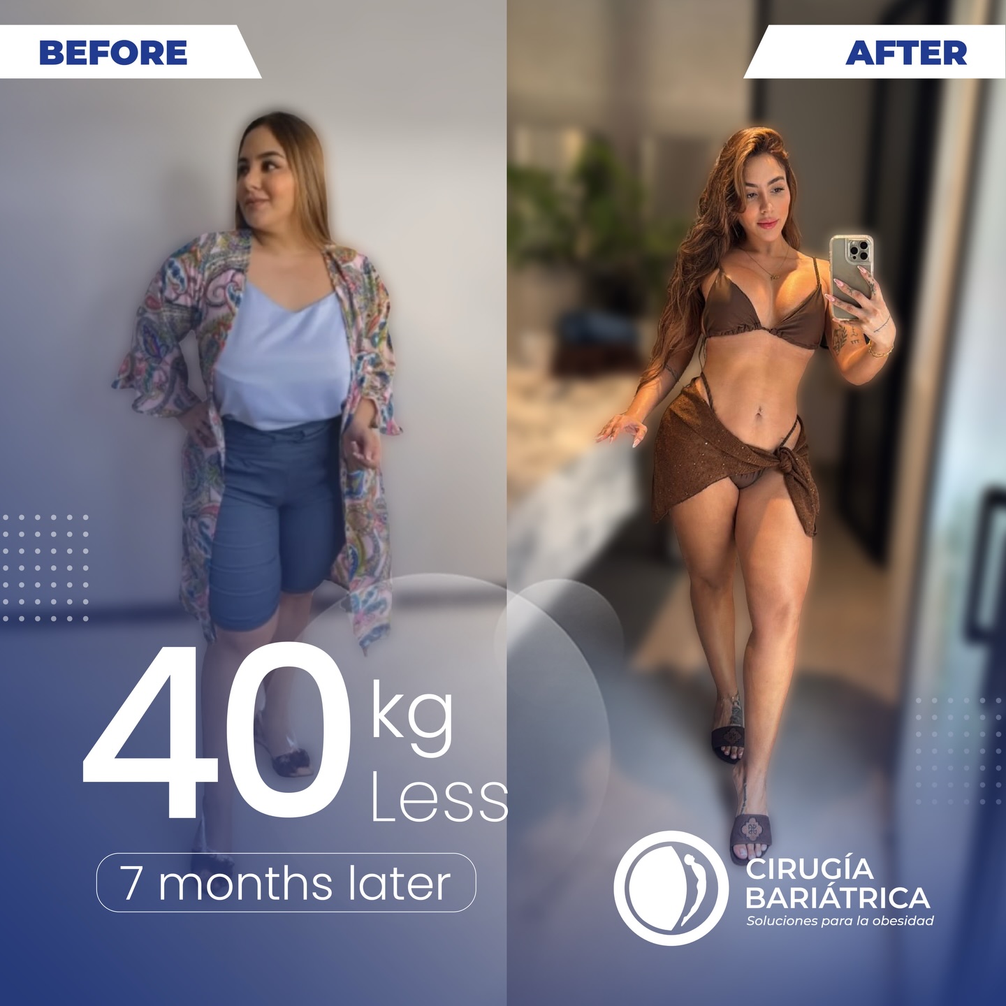 ✨ -40 kg en 7 meses 🙌🏽🔥
Nuestra paciente hoy está feliz y orgullosa con sus resultados y con la mejora real en su calidad de vida 💛
Gracias a su compromiso y al acompañamiento del Dr. Bolaños y su equipo, con profesionalismo, experiencia y alta tecnología, logrando resultados seguros y alineados a los objetivos de cada paciente. 🏥💪🏽
✨ -88 lb in 7 months 🙌🏽🔥
Our patient is now happy and proud of her results and the real improvement in her quality of life 💛
Thanks to her commitment and the support of Dr. Bolaños and his team, with professionalism, experience, and advanced technology, achieving safe results aligned with each patient’s goals. 🏥💪🏽
#bajardepeso #cirugiabariatrica #bariatricsurgery #beforeandafter #weightlosssurgery