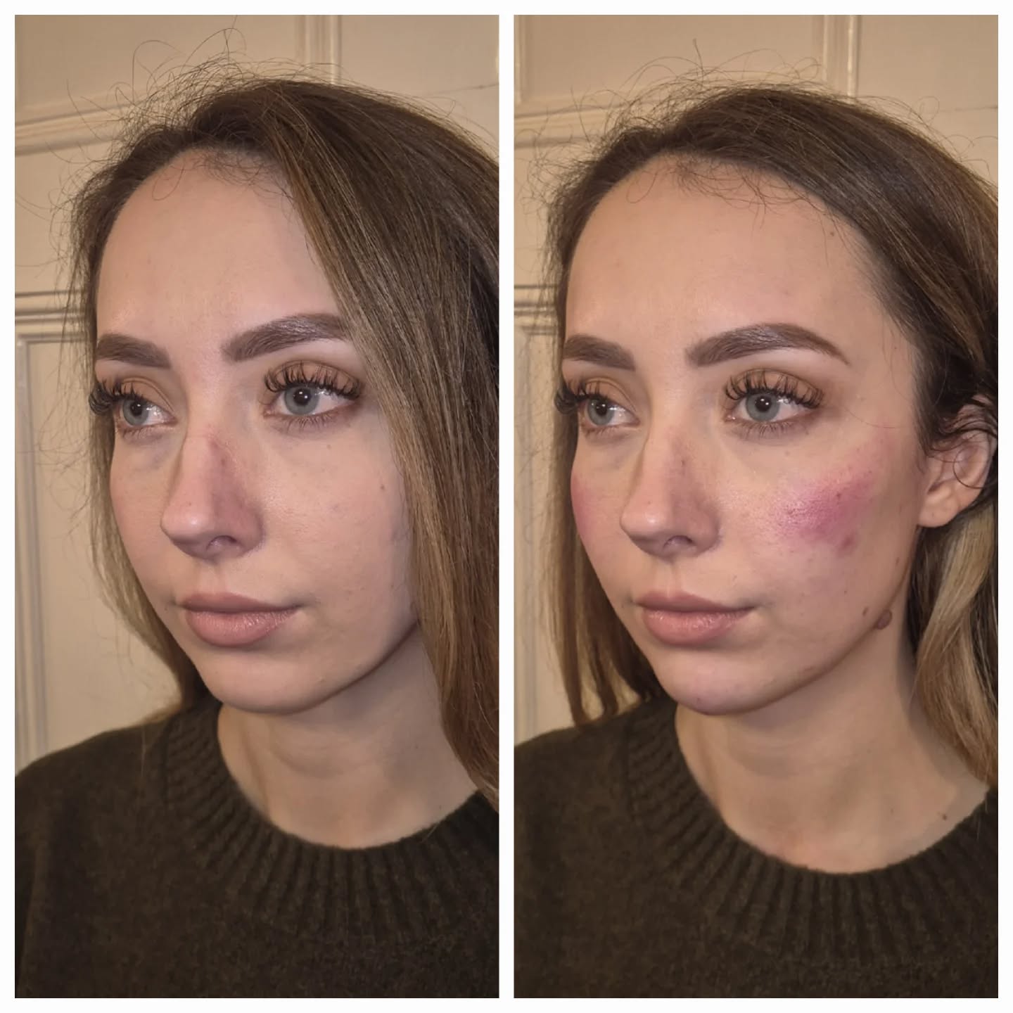 Facial balancing isn’t about changing features.
It’s about restoring harmony ✨
In this case, subtle chin and cheek filler were used to improve proportions, support the lower face, and enhance natural structure – without adding heaviness or volume for the sake of it.
🔹 The chin helps anchor the face and improve profile balance
🔹 The cheeks provide lift and soft support to surrounding tissues
🔹 Small, strategic amounts = refined, natural results
Often, the biggest changes come from the most conservative approach.
Less filler. Better placement. Better balance.
