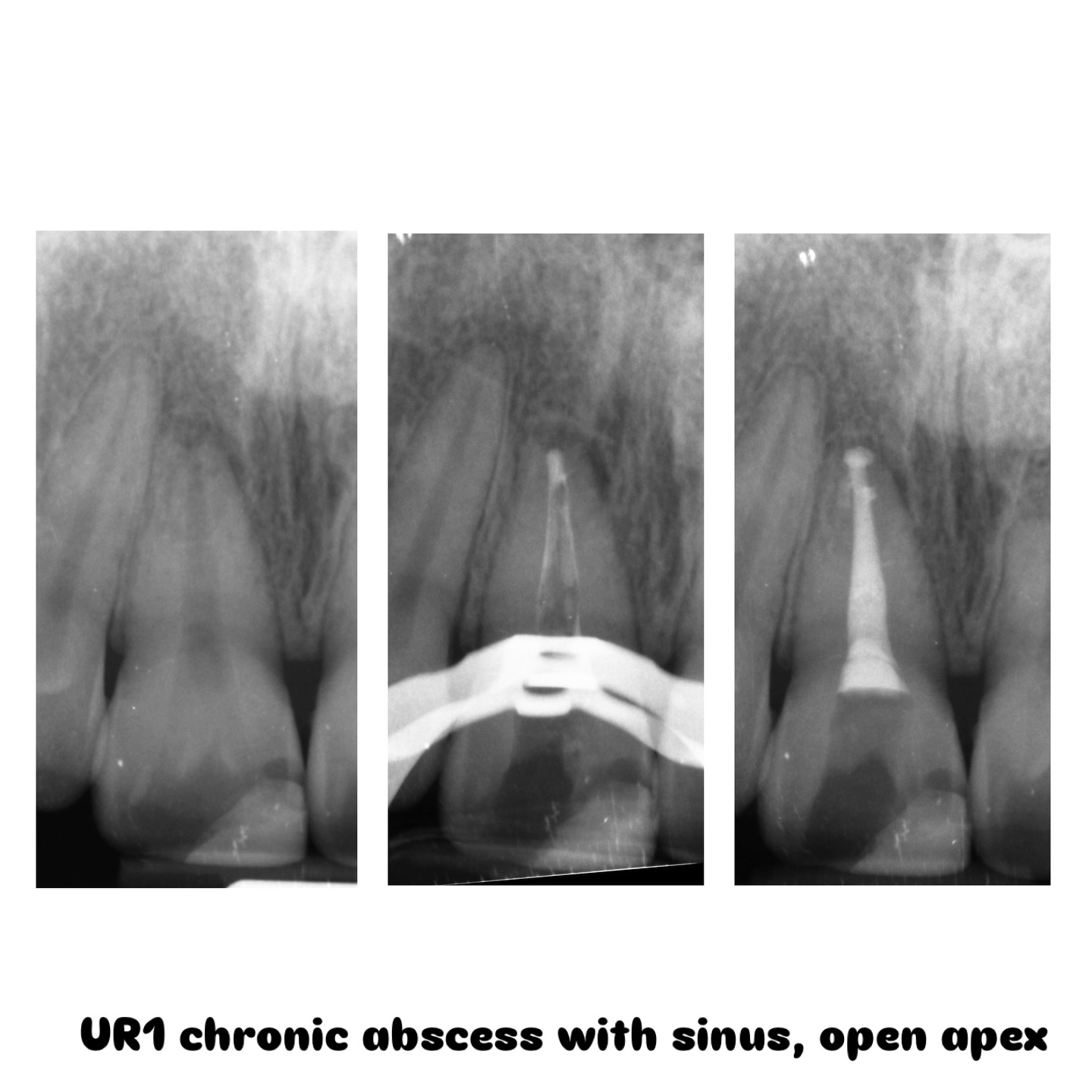 Endo UR1 dx— chronic abscess with draining sinus/PN. 2 visit endo with apical resorption. Deets in pics #rootcanaltreatment #openapex #endodontictreatment #endodontic #warmverticalcompaction