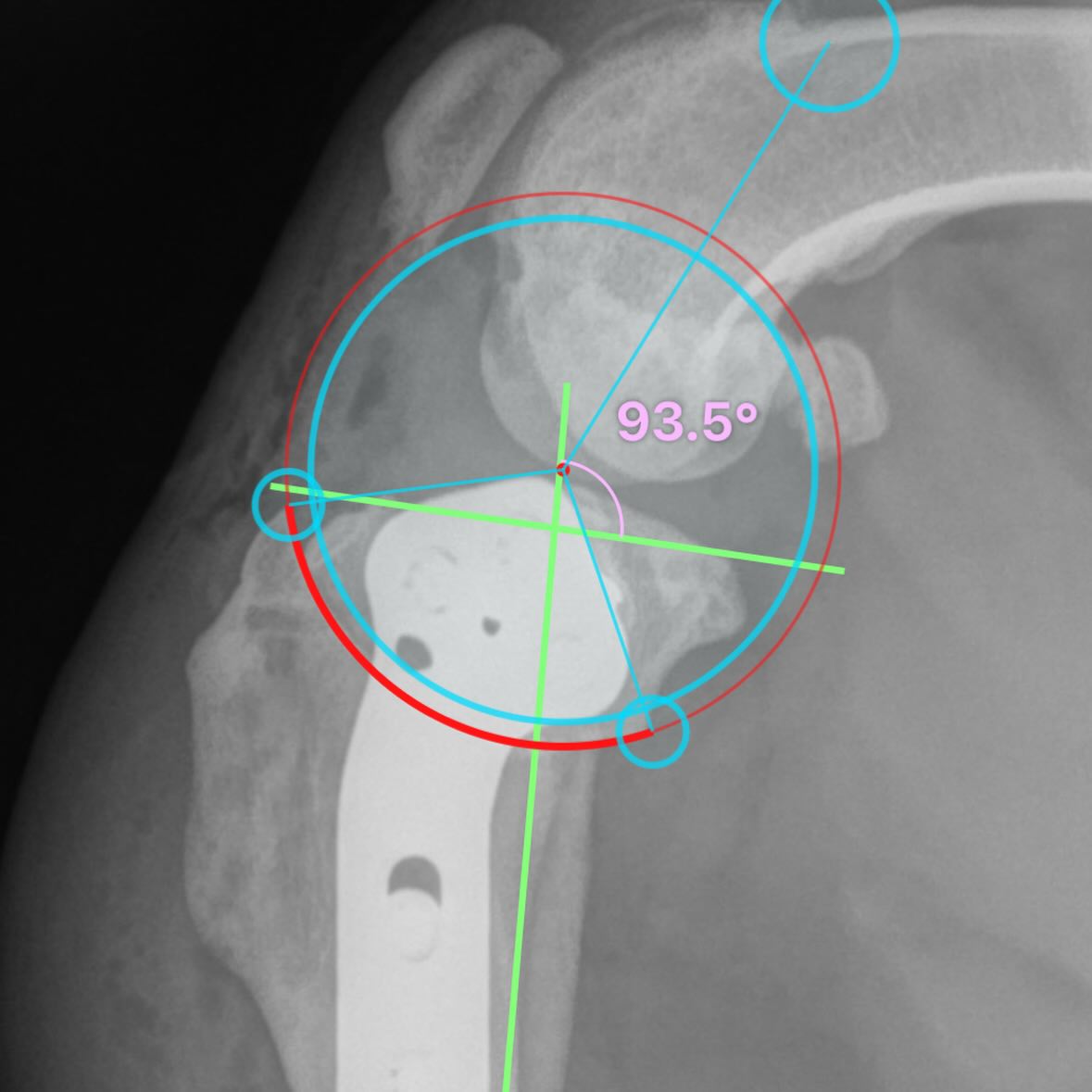 TPLO precision starts with osteotomy placement. From the side, the cut is centered over the intercondylar eminence to minimise mechanical axis change. From the front, it’s parallel to the joint to minimise deviation during rotation.