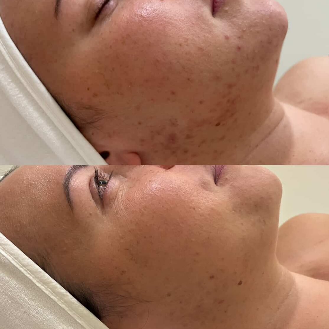 Consistency is the key!!
Each week we will post (with consent) before & after images of our skin transformations.
This result was achieved with:
• 2 x Salicylic Acid Peels
• 2 x Skin Needling with Exosomes
• Consistent use of Aspect Dr Medical Grade Skincare including:
~ Multi B Serum,
~ Absolute Corrective Serum,
~ Exfol A,
~ Ultra Light Moisturiser
We always recommend a course of 6 treatments for optimal, long-term skin change because real results come from consistency, not one-off treatments.
And remember… it’s not just about what we do in clinic. Your home care in between appointments is just as important.
Think of it as protecting your investment — supporting cell renewal, maintaining results, and allowing your skin to truly transform.
If you’re wanting help with your skin, then you’re in the right place. Our skin therapist Suzy offers complimentary skin consultations to discuss your concerns, goals and will design a treatment plan suited to your needs.
We look forward to hearing from you.
📞 0416447277
🌎 www.barebeautybrisbane.com
📧 info@barebeautybrisbane.com
📍 8 Stuart street, Bulimba, 4171
#skintransformation #skinhealth #skinpen #exosomes #medicalgradeskincare