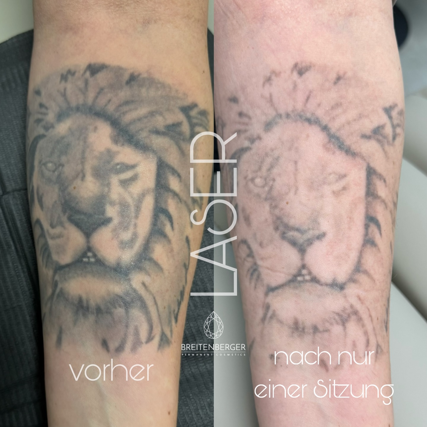 so kann dein Tattoo nach der ersten Laser Sitzung aussehen. Das nachher Foto ist einen Monat nach dem Lasern entstanden, es gab wie immer keine Blasen, Krusten, kein Blut und somit auch keine Narben.
Das ist meine oberste Priorität beim Tattoo Entfernen - maximale Ergebnisse mit minimalem Trauma.
Ich verwende einen medizinischen Picosekunden Laser der die Pigmente in Rekordgeschwindigkeit in kleine Partikel zersprengt, die dann vom Lymphsystem abtransportiert werden.
Du hast auch eine Jugendsünde, oder einfach ein Tattoo das mittlerweile einfach nicht mehr zu dir passt?
Dann buche gleich deinen Termin und starte den Weg zu klarer Haut. Sicher, schonend, und maximal Effektiv!
TATTOOREMOVAL
TATTOOENTFERNUNG SCHWEIZ
TATTOOENTFERNUNG VORARLBERG