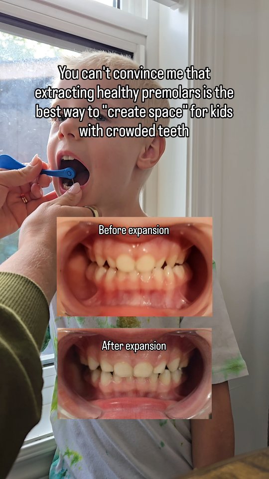 When a child’s teeth are crowded, it’s often a sign there wasn’t enough room for everything to grow the way it should.
What many parents aren’t told is that the roof of the mouth is also the floor of the sinuses. When that area is narrow, there is less space for nasal breathing. When it is supported to widen during growth, it can create more room not just for teeth, but for better airflow too.
That is why breathing matters so much. Mouth breathing, low tongue posture, and a narrow palate all affect how the jaws grow and how much space develops in the mouth.
This is why early intervention is so important. Being told to wait until they are older can mean missing the years when growth can actually be guided.
If you are being told your child needs healthy premolars removed, it is okay to pause and get a second opinion. Removing teeth is permanent, and families deserve to understand all the options first.
Sometimes extractions truly are necessary, and that matters. But when they are recommended routinely, it is fair to ask whether breathing, growth, and space were fully looked at beforehand.
You are not overthinking this.
You are advocating for your child.
👉 Comment "airway" below and we'll DM you
#myofunctionaltherapy #earlyintervention #kidshealth #parentsofinstagram #crunchymoms homeschool