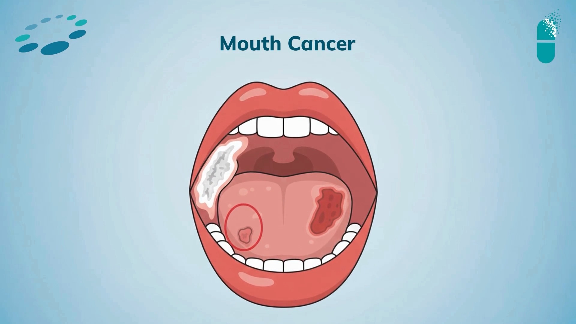 வாய்வழி புற்றுநோயின் பொதுவான அறிகுறிகள் என்ன?
.
.
.
📍Dr. N. S. Vimalathithan – Surgical Oncologist, Chennai
📞 +91 99628 66666
🌐 www.oncospecialist.com
.
.
.
#drvimalathithan
#chennai
#MouthCancer
#OralCancer
#OralCancerAwareness
#HeadAndNeckCancer
#CancerAwareness
#EarlyDetection
#PreventCancer