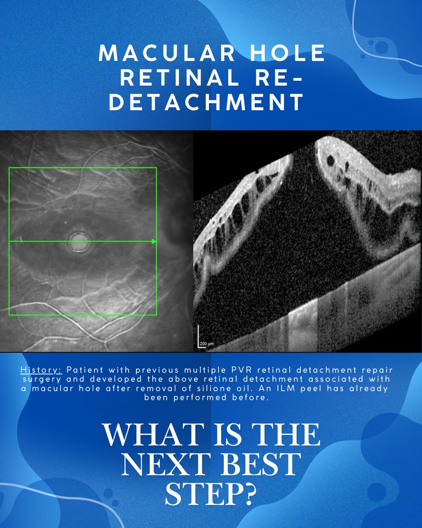 Rare but sometimes happen in cases with multiple retinal detachment surgery especially if complicated with proliferative vitreoretinopathy (PVR).
What would you do in a case of macular hole formation related retinal detachment following removal of silicone oil and with previous internal limiting membrane (ILM) peeling?
Some choices are as follows:
1) No further surgery.
2) ILM flap into hole.
3) Retinal autograft into hole.
4) Amniotic membrane graft into hole.
Will present video and outcome in a future post.
#macularhole #retinaldetachment #vitreoretinal #ophthalmology #eyedoctorchng