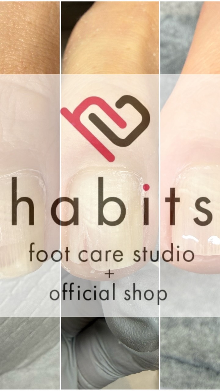 【アンケート付き】
亀裂が続いてお困りのお客様です。
亀裂が続く理由は複数考えられます。
まずはカットで様子見。そこから今回は人工爪で様子見となりました。
経過をアップして行きますので、フォローしてお待ちください!
#habits #footcare #青葉台 #横浜市 #青葉区
アンケート回答お願いいたします
亀裂で悩んだことがありますか?