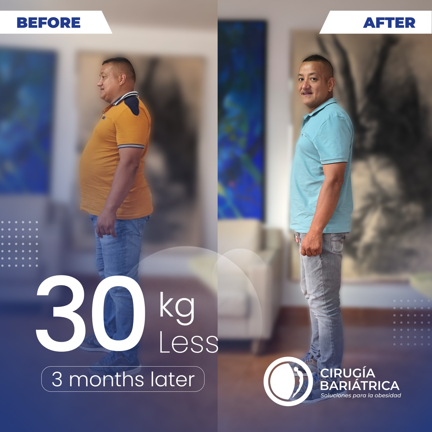 ✨ 30 kilos menos en solo 3 meses ✨
Un cambio real, visible y lleno de salud 🙌
Este resultado es posible gracias a la cirugía bariátrica, respaldada por la gran tecnología, la precisión médica y el alto profesionalismo del Dr. Eduardo Bolaños y su equipo de trabajo.
Cada proceso es acompañado con compromiso, experiencia y un enfoque humano que prioriza el bienestar y los resultados reales de cada paciente.
Más que una transformación física, es una nueva oportunidad de vida 💙
Resultados que hablan por sí solos.
#bariatricsurgery #bariatrica #weightlosssurgery #weightlossjourney #healthandwellness
