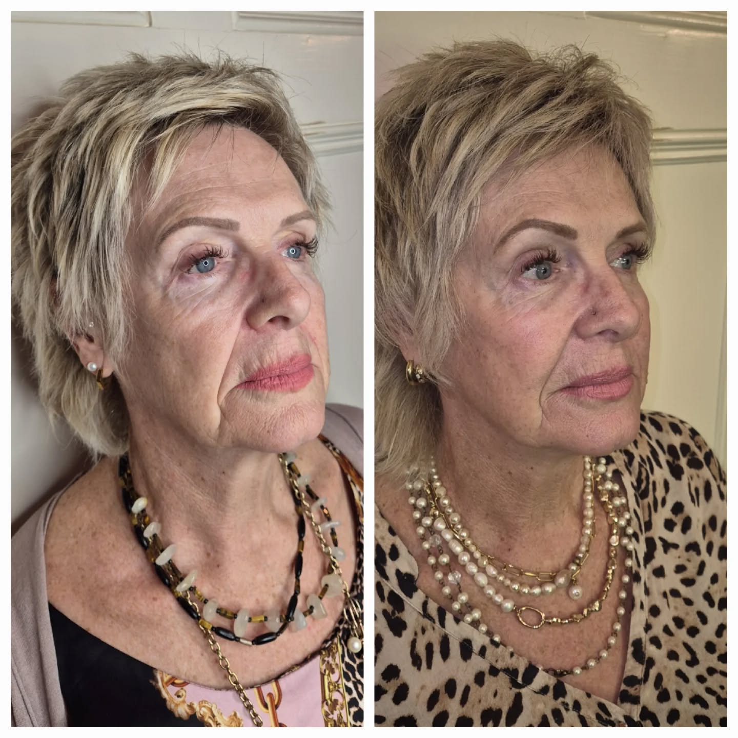 AFTER ONE SESSION OF PLLA! 😍
Poly-L-Lactic Acid (PLLA) is not a traditional dermal filler. It is a biostimulatory injectable designed to work with your body rather than simply adding instant volume.
Unlike hyaluronic acid fillers that give an immediate plumping effect, Poly-L-Lactic Acid works by stimulating your own collagen production. Once injected, the product gradually encourages fibroblasts in the skin to produce new collagen, helping to rebuild structure, improve firmness, and restore volume over time.
This is why results with PLLA are progressive and natural-looking. The initial improvement you may see shortly after treatment is often related to hydration from the injection process, but the true results develop gradually over weeks to months as collagen forms. Because of this, patience is essential and outcomes tend to look subtle, balanced, and long-lasting.
Poly-L-Lactic Acid is particularly effective for: • Global volume loss
• Skin laxity and thinning
• Loss of facial structure and support
• Improving overall skin quality rather than changing facial shape
Treatment is usually performed as a course, with sessions spaced several weeks apart, allowing collagen to build steadily. Results can last up to 2 years or more, depending on the individual, lifestyle factors, and treatment plan.
The before-and-after images shown demonstrate how collagen stimulation can gradually restore volume and improve facial support without looking overfilled. This treatment is ideal for patients who want long-term rejuvenation, not instant enhancement.
Always remember: PLLA is about rebuilding, not filling.