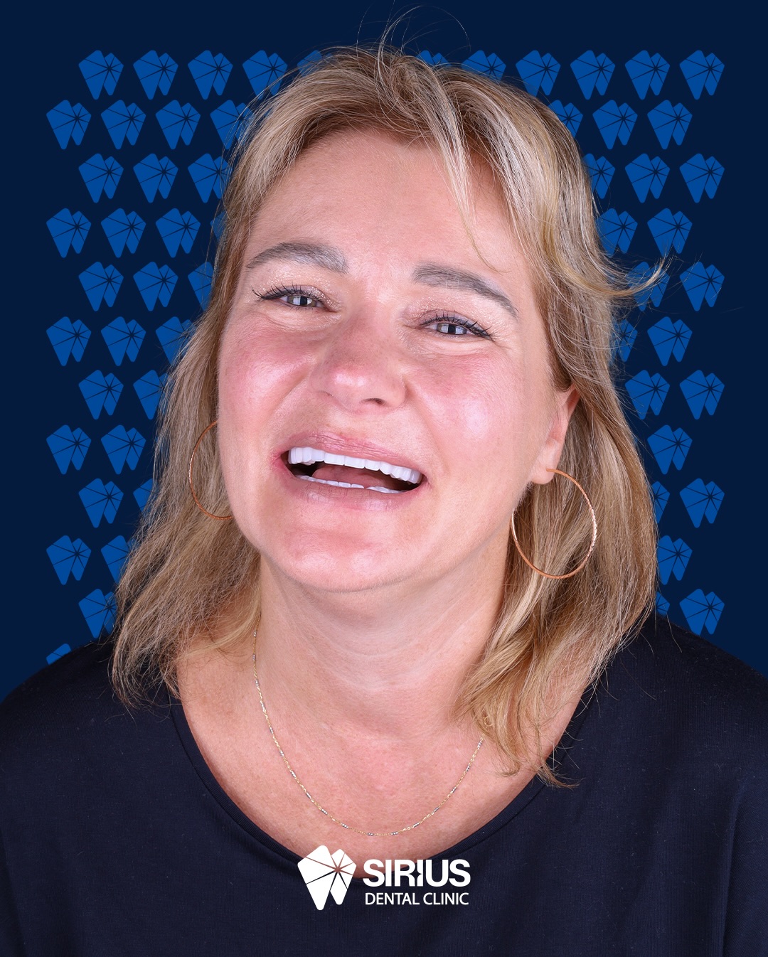 ✨ The journey is complete!
When Elena Smirnova first visited us, we began her smile transformation with zirconium crowns on the upper jaw and four implants on the lower jaw. Step by step, her dream smile came to life and today, that journey is beautifully complete! 😍
At Sirius Dental Clinic, we’re proud to not only restore smiles but to witness the happiness that comes with them. Thank you, Elena, for trusting us on this wonderful transformation journey!
#siriusdental #smiledesign #implant #zirconium #dentaltourism