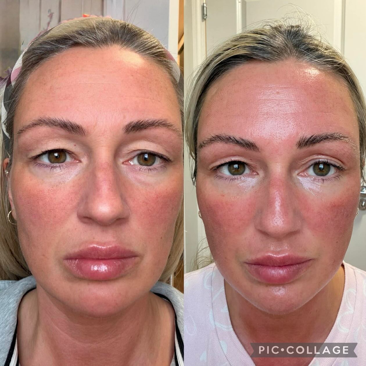 Before ➝ 3 days after full face CO₂ laser ✨
This is exactly why full-face CO₂ is such a powerful skin treatment.
Even at this early stage you can already see:
• More open, brighter eyes
• Visible tightening through the upper lid area
• Smoother skin texture
• Improved firmness and overall skin quality
The eye area in particular looks refreshed and lifted — without injectables, without surgery, and without altering her natural features.
This is true skin restructuring, not a temporary fix.
✨ MODEL CALL ✨
I’m currently looking for just 3 more models for full-face CO₂ laser.
💷 Model price: £200
🗓 Appointments available this Friday:
• 11:00
• 12:00
• 1:00
• 2:00
First come, first secured.
This is ideal for clients who:
• Want visible tightening and skin refinement
• Are ready to invest in long-term skin quality
• Prefer advanced treatments with real results
