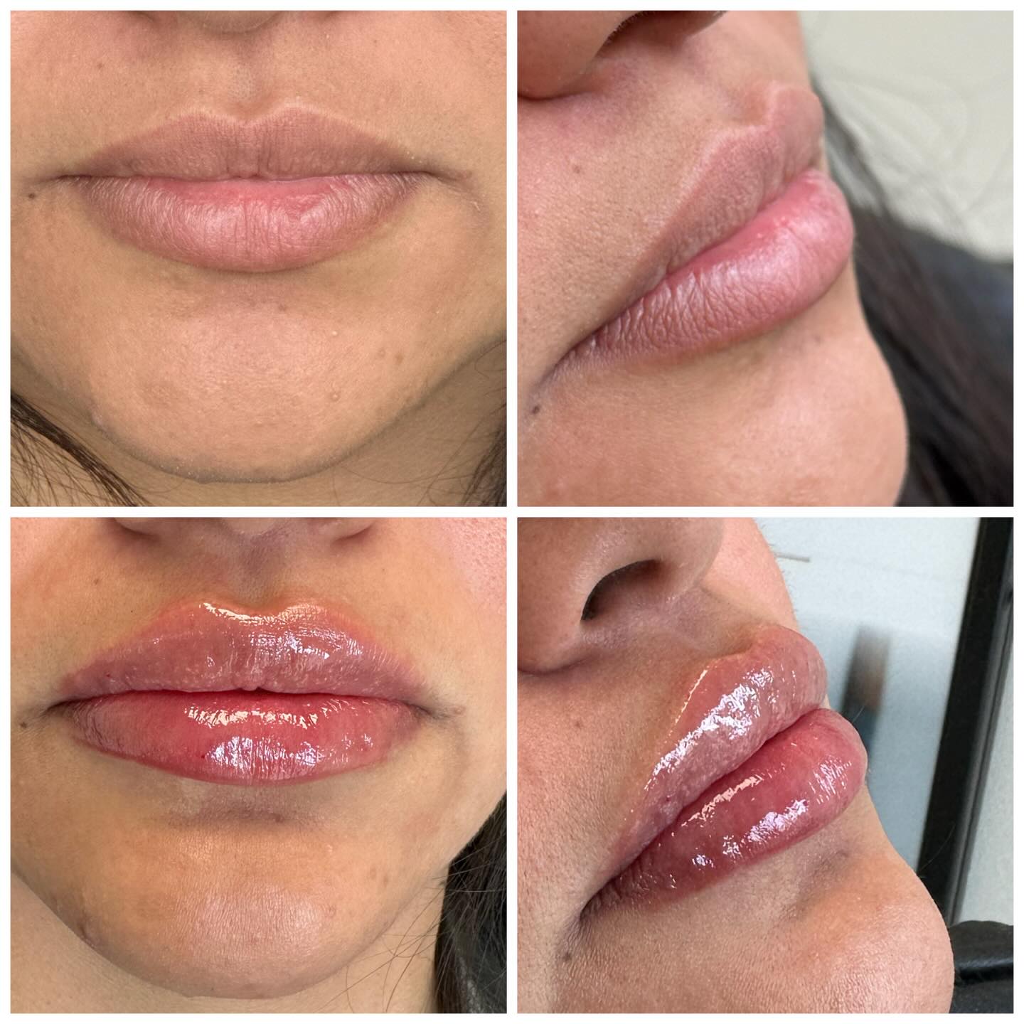 A quick lip refresh to start the new year right😉
Did you know I offer a Mini lip filler appointment? 💋
A mini lip fill is just half a syringe! This is perfect for those that just need a little subtle enhancement, want added hydration, or if you are new to lip filler and want to see what filler can do for you !
📆 Book a consultation or DM to see if a mini lip or full
syringe is right for you!
📲 971-375-6381
✨Un retoque mini de labios para empezar el año bien.
¿Sabías que ofrezco citas para un mini relleno de labios?💋
Un relleno de labios “mini” consiste en solo media jeringa; es perfecto para quienes solo quieren un aumento natural y sutil, desean mayor hidratación o si es la primera vez que se someten a un relleno labial y quieren ver qué resultados pueden obtener.
✨ Manda mensaje o 📲 971-375-6381 para ver si está
es una buena opción para ti 💁🏻♀️