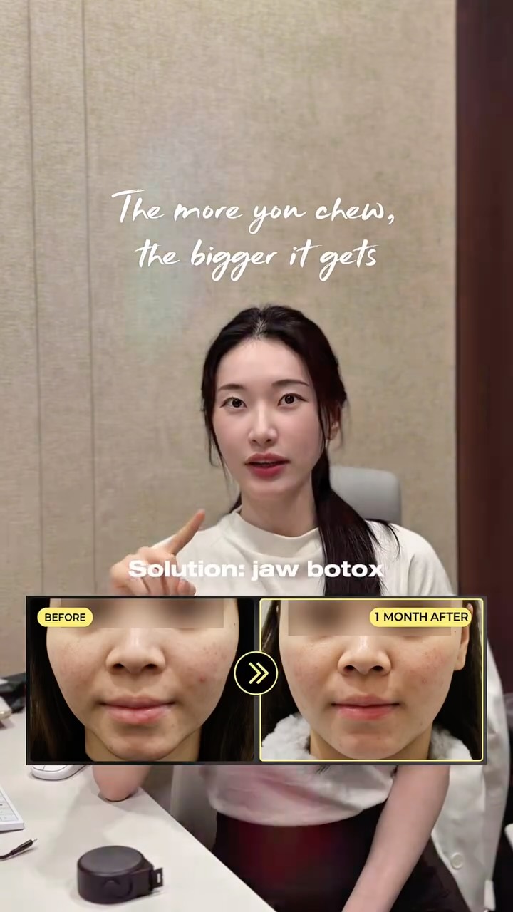 Are you ruining your face shape without knowing it? 😱
Dr. Jihye says DELETE these 7 bad habits immediately for a natural glow up:
❌ Crossing Legs (Bad for alignment)
❌ Using Straws (Lip wrinkles)
❌ Mouth Breathing (Weak jawline)
❌ Resting Chin on Hand (Asymmetry)
❌ Looking Down at Phone (Neck wrinkles)
❌ Low Tongue Posture (Double chin)
❌ Chewing Ice/Tough Food (Square jaw)
Which one is hardest for you to quit? I’m guilty of #2! 🙋♀️
#forenaclinic #koreanskinclinic #fyp #kbeauty