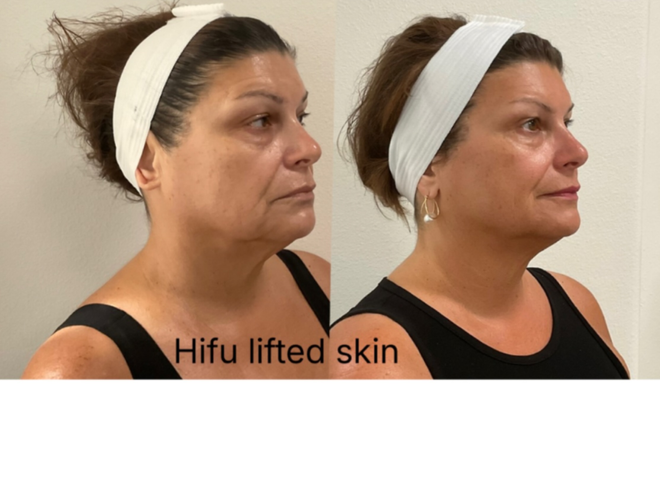 Look 10 years younger just after ONE HIFU treatment..
Book your free consultation NOW …and get 25% off you treatment..
http://capricebeautybar.com/