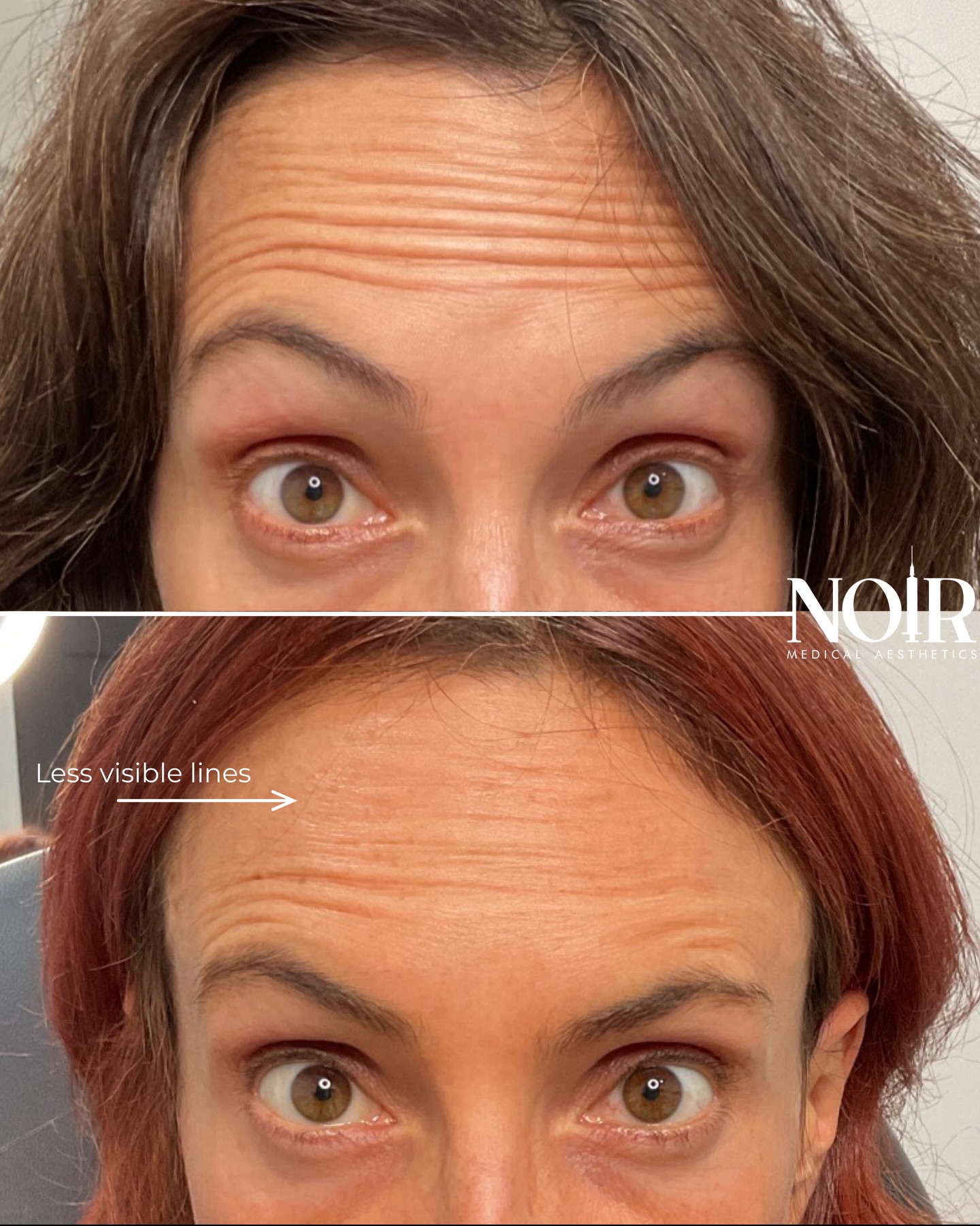 This is what two years of consistent neurotoxin treatments every 3–4 months can do. 😍✨
Notice the improved smoothness at rest and how full muscle movement has not returned? This photo was taken right before we re-treated her at the 3-month mark, when she was due for her next treatment.
✨Both images shown are before photos.✨
Our goal is to gradually relax the muscle so it doesn’t come back at full force and create etched-in lines over time. With consistency, many patients are able to space out treatments and need fewer units while still maintaining natural, refreshed results.
Want to be wrinkle free? Book a tox appointment with us.