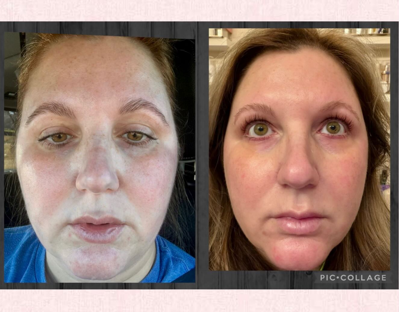 Custom skincare + a medium-depth chemical peel 🤍
This before & after highlights improved tone, texture, and overall skin quality after personalized homecare and proper healing.
Powerful treatments deserve the right foundation.
Every plan is unique. Every result earned.
✨ No injectables were used for this glow up.
📍 Southern Bell Aesthetics
📲 Text or DM to book: (865) 556-2451
#ChemicalPeel #SkinTransformation #HealthySkinJourney #ProfessionalSkincare #CustomSkincare #BeforeAndAfterSkin #SkinConfidence #GlowingSkin #SouthernBellAesthetics