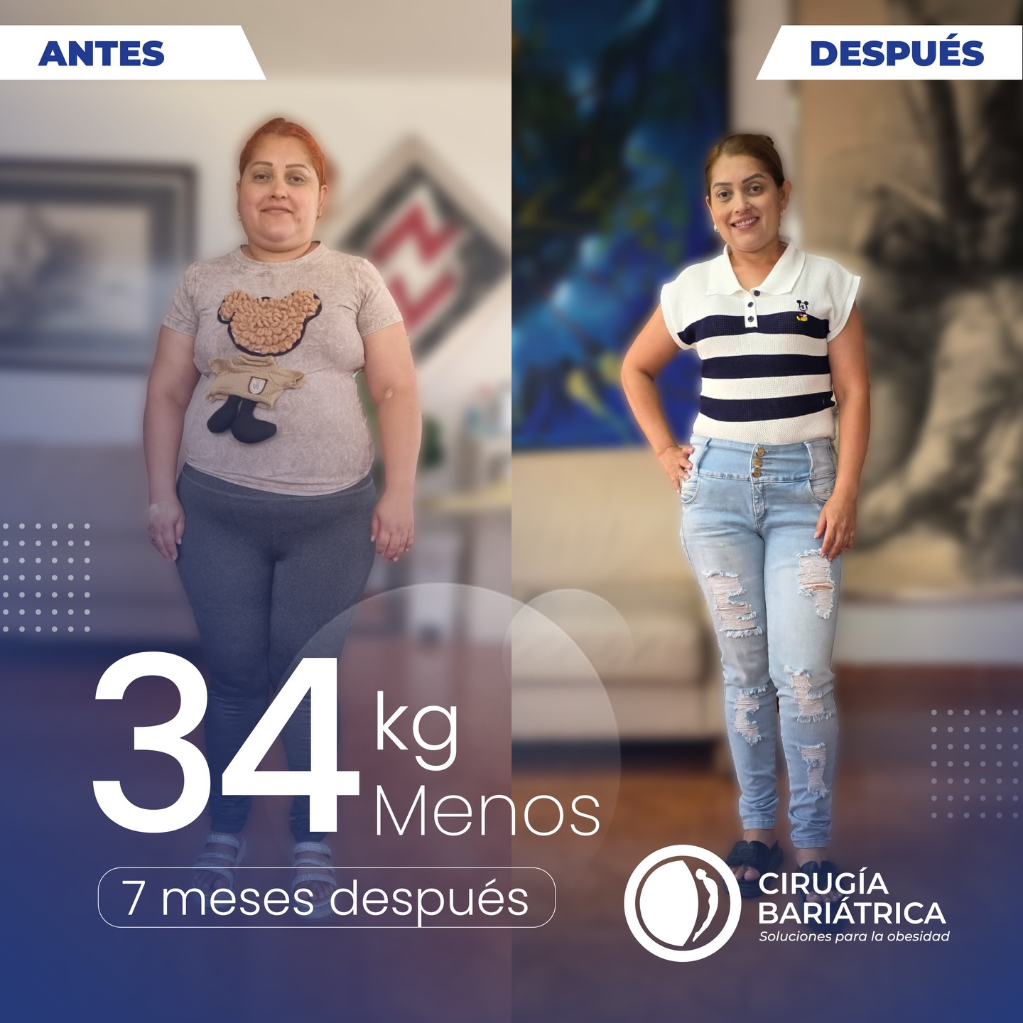 34 kilos menos en solo 7 meses ✨
Resultado de un proceso hecho con alta tecnología, compromiso y profesionalismo, de la mano del Dr. Bolaños y su equipo de trabajo 💪🏽
Cada historia es única, y cada logro es el reflejo de un acompañamiento médico responsable y humano.
¡Vamos por una vida más saludable! 🌱
75 pounds down in just 7 months 💫
The result of a process supported by advanced technology, commitment, and professionalism, led by Dr. Bolaños and his medical team 💪🏽
Every transformation is unique and reflects responsible, high-quality medical care.
Here’s to a healthier life 🌱
#bariatricsurgery #bariatrica #weightloss #healthy #bajardepeso