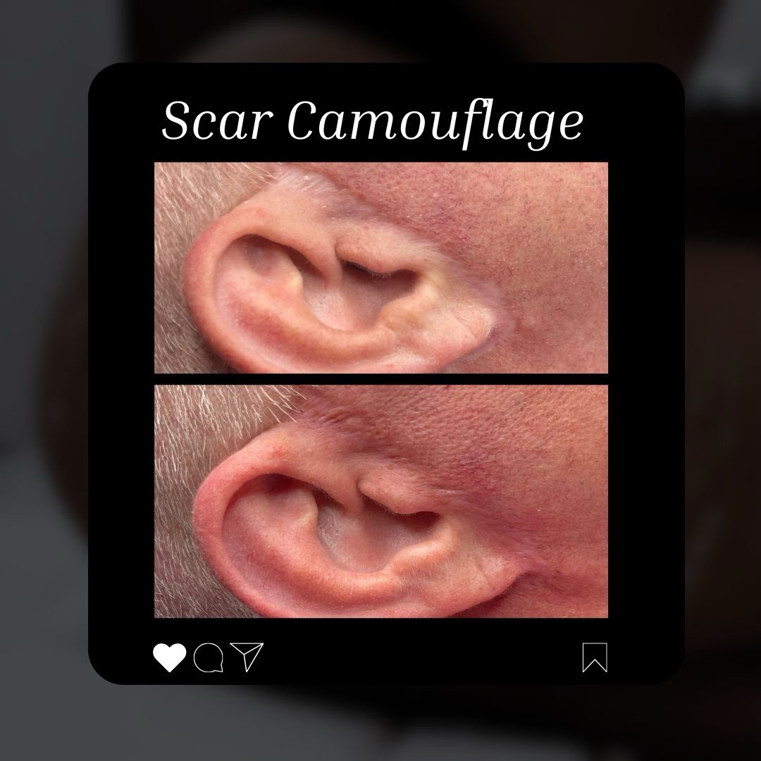 Before & After: Facelift (Rhytidectomy) Scar Camouflage
WHAT IT IS
Specialized Tattooing: A technique under medical/paramedical tattooing that uses a medical-grade machine to implant pigment into scar tissue.
Scar Camouflage: Aims to disguise scars, especially white (hypopigmented) ones, by adding color where pigment is missing.
Skin Tone Matching: Artists meticulously match pigments to your unique skin tone for a seamless blend.
HOW IT WORKS
Pigment Application: Pigments are placed into the scar tissue to match the surrounding skin, reducing the contrast.
Texture & Color: Techniques can also help improve skin texture and induce collagen, making scars appear smoother and less defined.
Restorative Art: It’s a form of restorative art that combines medical knowledge with artistic skill to improve physical appearance and emotional wellbeing.
BENEFITS
Reduces Visibility: Makes surgical incision lines much less noticeable.
Boosts Confidence: Helps individuals feel more comfortable and whole by minimizing visible scarring.
Long-Lasting: Provides a durable solution, though touch-ups may be needed over time as skin ages.
BOOK YOUR CONSULTATION OR APPOINTMENT TODAY!
www.beatandblade.com
Enhancing Lives One Image At A Time ™️
#beforeandafter #facelift #medicaltattoo #scarcamouflage