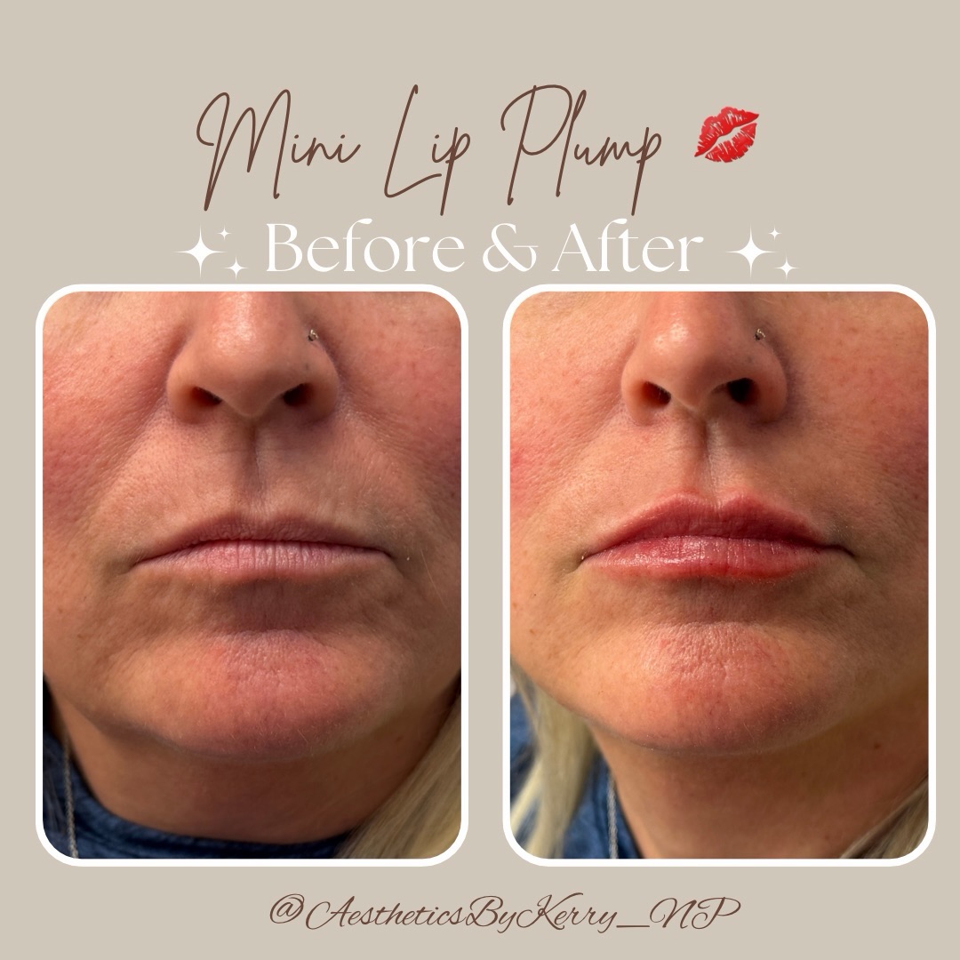 Beautiful lip enhancement for an already beautiful client! ✨💉
Subtle volume. Restored hydration. Softened vertical lines. This is what natural lip enhancement should look like! 💋
Interested in subtle, natural lip enhancement? Schedule your visit at Revitalized Healing:
📲: (954)-478-7225
🌐 www.vitalhealing247.com
📍 6279 W. Sample Road, Suite 305
Coral Springs, FL 33067
.
.
#clienttransformation #hydratedlips #injectables