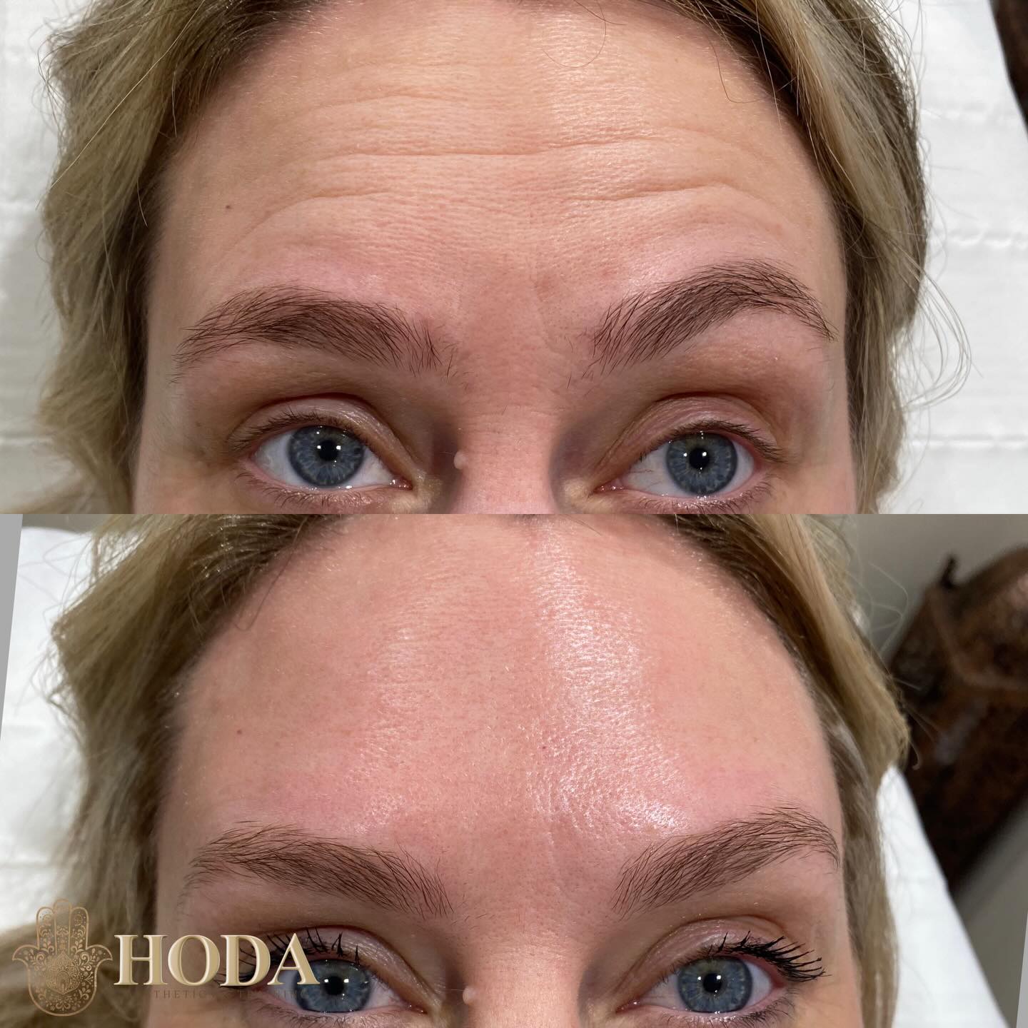 Guess the treatment area?
Anti-Wrinkle Injectables work to prevent the formation of static wrinkles by stopping the signal between the nerve and muscle. The decreased movement in the muscle places less stress on the skin helping you maintain a fresh and youthful appearance.
Did you guess correctly?
We treated both her forehead and frown lines!
This treatment is most effective when used as a preventative measure.
๐ฒ DM book with Hoda
๐ฉ๐ผโโ๏ธ Nurse Led-Aesthetic Clinic
๐ Bournemouth, Dorset
#bournemouthantiwrinkle #fillerbournemouth #bournemouthsalon #bournemouthfillers #aesthetic