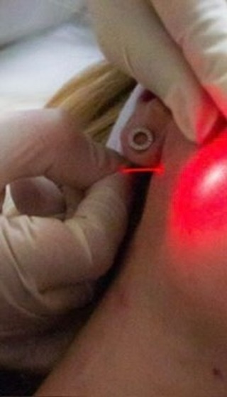 BEFORE YOU BOOK ANYTHING ELSE THIS YEAR. WATCH THIS !
Endopulse treatment is a minimally invasive, non-surgical laser procedure that tightens skin, reduces fat, and boosts collagen by delivering precise laser energy through a fine fiber inserted under the skin, offering a lifted and contoured appearance with little downtime.
Ideal for facial and body rejuvenation. It works by stimulating collagen production and gently melting fat, providing a modern alternative to facelifts for improving skin laxity and contour.
How it works
Laser technology: A specialised laser (often 970nm) is delivered via a thin fiber inserted just beneath the skin’s surface.
Collagen stimulation: The laser energy heats the deeper skin layers, prompting the body to produce new collagen, which tightens the skin.
Fat reduction: The energy also targets and reduces localised fat deposits.
Tissue lifting: This combination leads to skin tightening, fat reduction, and a lifted, more contoured look.
Key features
Minimally invasive: No large incisions or stitches are needed, just a small entry point for the fiber.
Little downtime: Mild redness or swelling may occur, but recovery is generally quick.
Targeted: Treats sagging skin and fat on the face, neck, and body.
Results: Immediate tightening, with full results developing over weeks as collagen regenerates.
Benefits
Non-surgical alternative to facelifts, Reduces skin laxity and improves elasticity, Contours the face and body, and Can offer long-lasting results.
Results last: 1-2 years.
#facelift #skinlifting #skinclinic #skinspecialist #skintightening