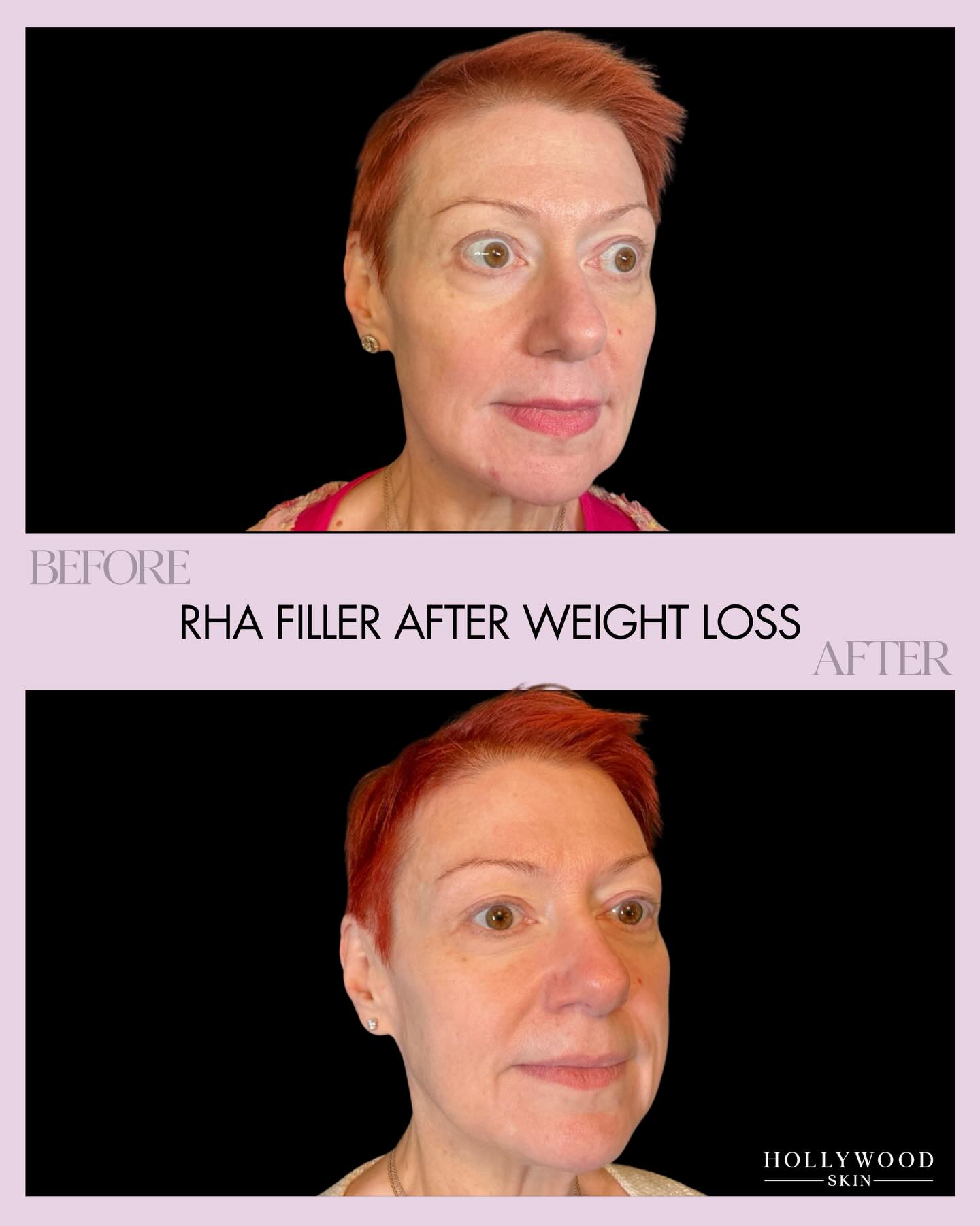 This one hits different.
After losing 225 pounds and keeping it off for two years, this client came in ready to restore balance, structure, and softness to her face. With 5 syringes of RHA filler, we focused on supporting the areas that naturally lose volume and definition after major weight loss.
Treated areas included:
Cheeks
Jawline
Temples
Chin
“Smoker’s” lines
Lips
One of my absolute favorite results to be a part of!
HWSkin.com
#HollywoodSkin #RHAFiller #Filler #DermalFiller #ParkRidgeInjector