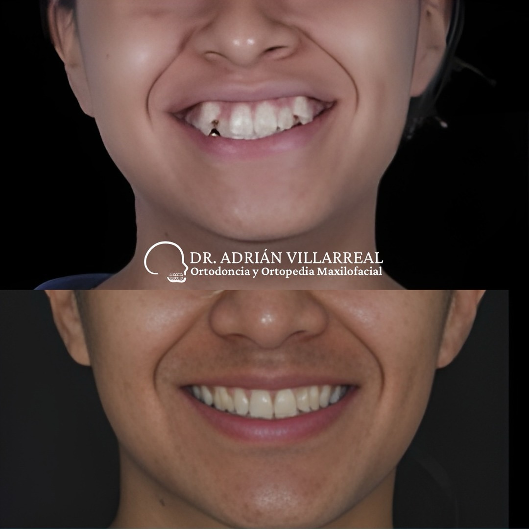Cambios reales que transforman tu 😃 Brackets + Extracciones 🙌🩷
🦷 Agenda tu valoración y toma la mejor decisión.
.
.
.
.
UANL Ced. Prof. 12948881
UANL Ced Maestria: 14532598
COFEPRIS: 2419032002A00440
.
.
.
#dentistamonterrey
#odontologo
#brackets
#dentistasanpedro
#Ortodoncista