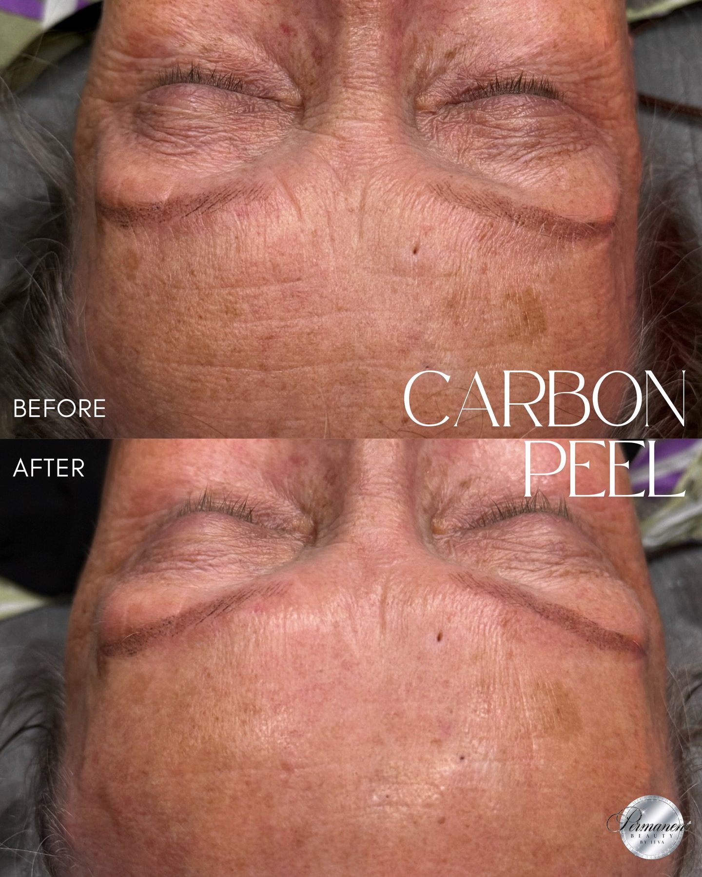 ✨ Carbon Peel: glow you can see, renewal you can feel
This is her very first Carbon Peel session and these photos were taken immediately after the treatment, with no serums, no filters, and no products applied yet. Skin already has glow and visible freshness ✨
✨ How does Carbon peel work?
A thin layer of medical-grade carbon is applied to the skin. When activated with a laser, it gently exfoliates the surface, deeply cleanses pores, and stimulates collagen production in the deeper layers.
✨ Why do clients love it?
• Instantly brightens dull, tired skin
• Smooths fine lines and softens wrinkles
• Improves skin texture and tone
• Refines pores
• Leaves skin clean, fresh, and glowing
✨ Why is now the perfect time?
Carbon Peel is best performed during seasons with less sun exposure. The skin recovers beautifully, and results are even more effective.
📩 Book your Carbon Peel and give your skin the glow it deserves.
____________________________________________________
Permanent Makeup Services, Tattoo Removal & Carbon Laser Facial
⬆️Book apt with the link in bio
✨Free Consultation available
📍Oshawa, Ontario
✉️ browsbyieva@gmail.com
📱 +1 416-804-6749
Website: permanentbeautybyieva.com
#carbonpeel #oshawafacials #whitbyfacials #oshawamedspa #oshawasalon