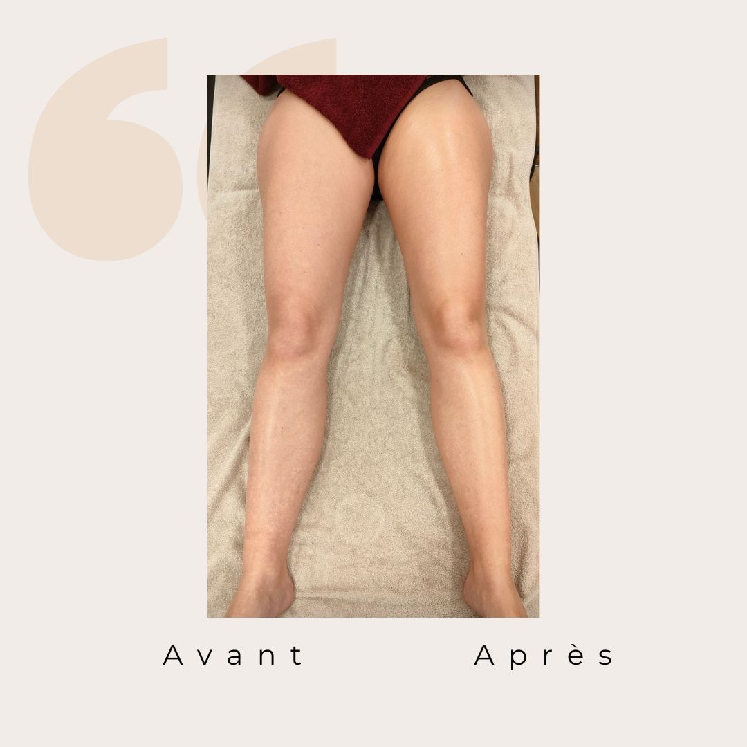 ✨ Avant / Après – Drainage lymphatique Renata França ✨
Dès la première séance, le corps réagit.
Des jambes visiblement plus légères, un galbe redessiné et une sensation immédiate de bien-être 🌿
Le drainage lymphatique Renata França agit en profondeur pour :
✨ stimuler la circulation lymphatique
✨ réduire la rétention d’eau
✨ affiner et détoxifier les jambes
✨ apporter une sensation de légèreté durable
Résultat visible, ressenti immédiat 🤍
Chaque corps est unique, les résultats peuvent varier, mais la légèreté, elle, est toujours au rendez-vous ✨
#drainagelymphatique #renatafranca #avantapres #jambeslegeres #retentiondeau #bienetre #soincorps #detox #momentpoursoi