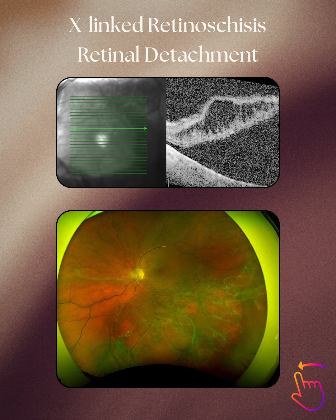 A young patient with known X-linked retinoschisis presenting with total macular off retinal detachment (RD) Grade PVR CP in an amblyopic (lazy) eye.
The obvious choice would be no surgery as visual prognosis was poor with such advanced RD and an amblyopic eye with limited visual gain. However, the patient and ourselves decided to go ahead with the surgery and not be deterred with the challenge. Thankfully the retina reattached after vitrectomy, encirclement buckle and silicone oil. After the silicone oil removal, the retina remain attached and the patient was very happy that some useful peripheral vision returned.
#retinaldetachment #vitrectomy #retina #ophthalmology #eyedoctorchng