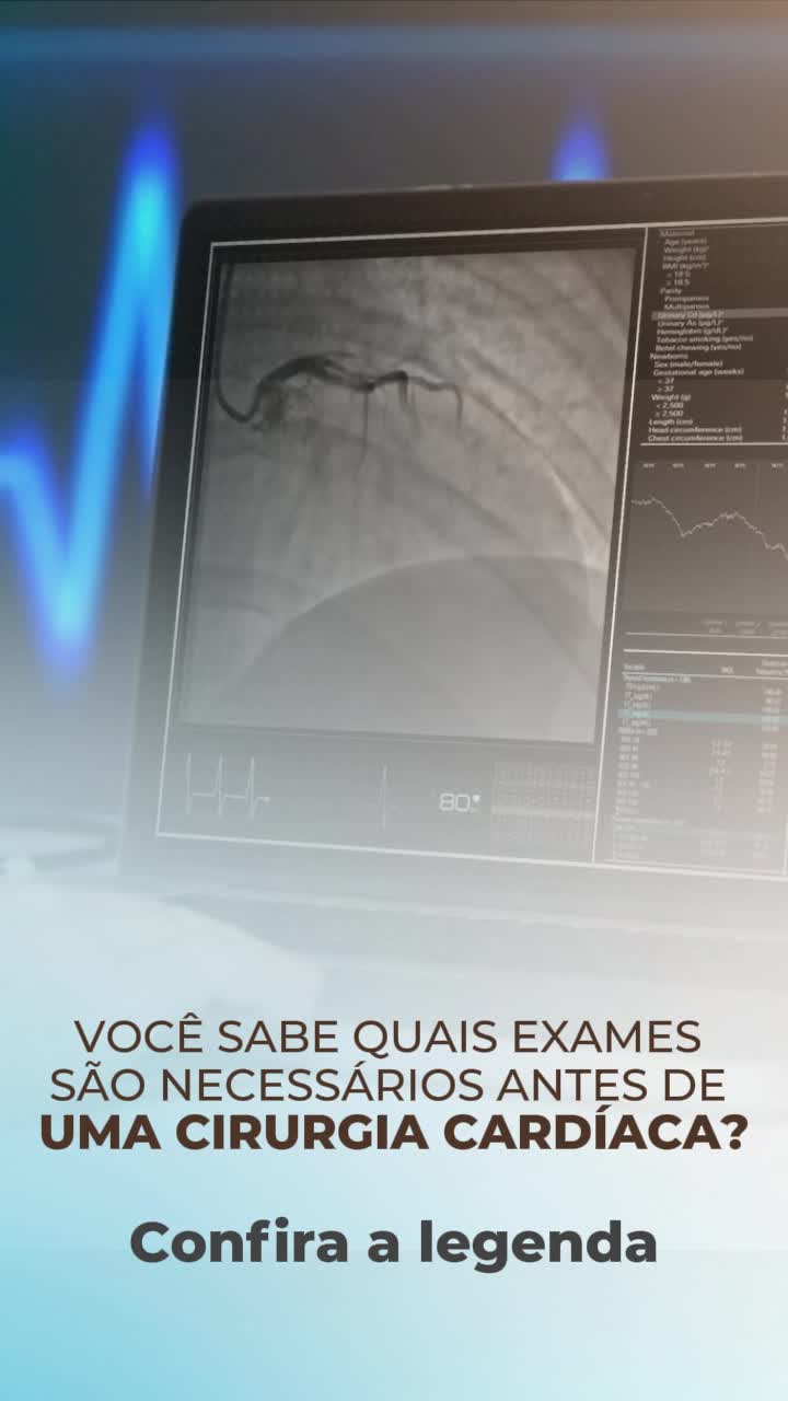 Antes de uma cirurgia cardíaca, a etapa mais importante é a avaliação completa do coração e do organismo como um todo. Esses exames permitem entender como está a função cardíaca e identificar qualquer fator que possa influenciar o procedimento.
Entre os principais estão:
🩺 Eletrocardiograma (ECG) — Analisa o ritmo do coração.
🖥️ Ecocardiograma — Avalia estrutura e funcionamento cardíaco.
🖼️ Tomografia e ressonância — Detalham anatomia e possíveis obstruções.
🩻 Cateterismo — Observa a circulação nas artérias coronárias.
🧪 Exames de sangue — Avaliam inflamação, coagulação, hemoglobina, função renal e outros fatores importantes.
Cada exame oferece informações essenciais para garantir segurança e melhores resultados no procedimento.
Cuidar bem começa com o diagnóstico certo.
#CirurgiaCardíaca #ExamesCardíacos #PréOperatório #SaúdeDoCoração #Cardiologia #CoraçãoSaudável #DrEdmoAtiqueGabriel #MedicinaCardiovascular #AvaliaçãoCardíaca #CuidadosComOCoração