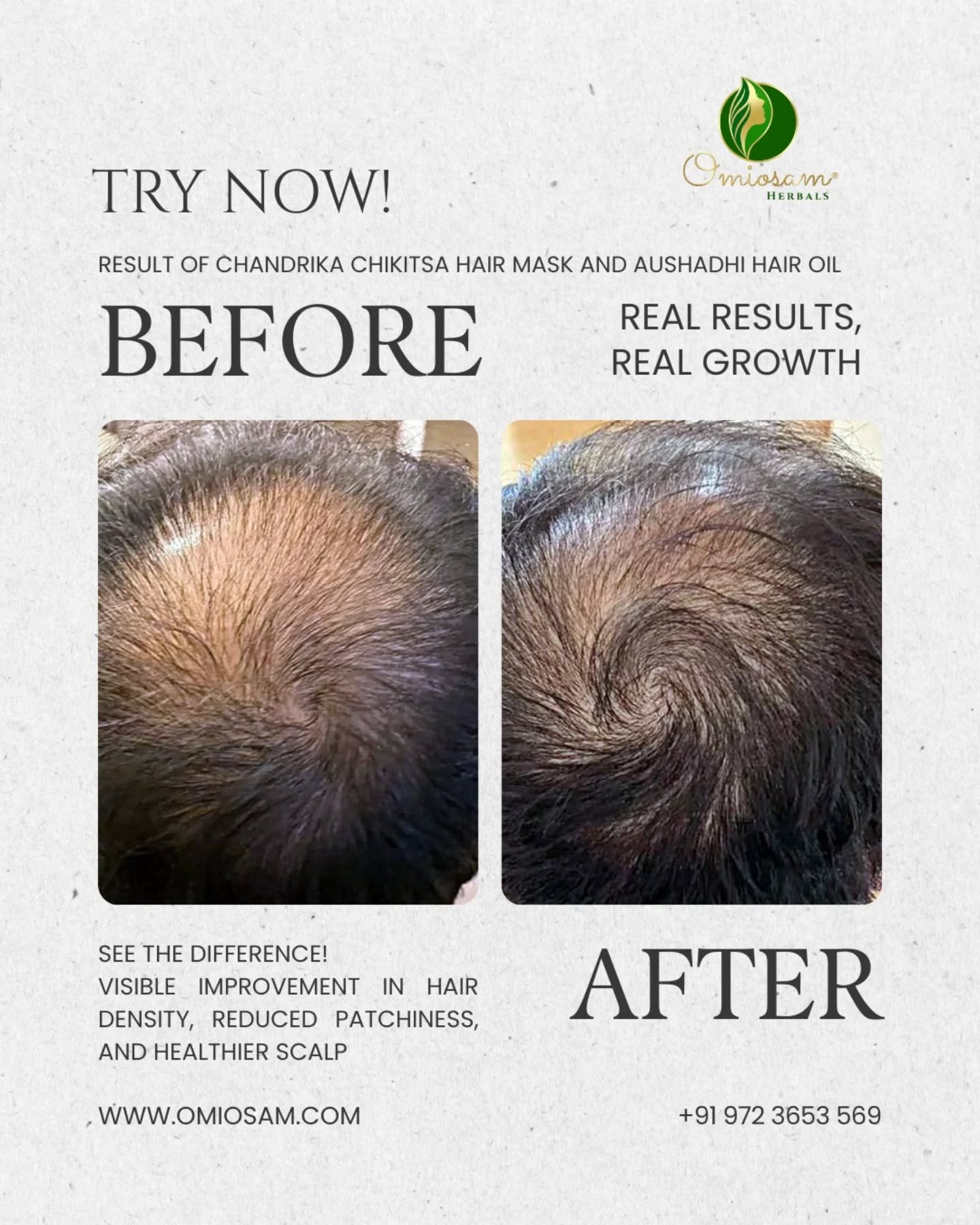 From Patchy to Powerful – Real Results with Omiosam Chandrika Chikitsa Mask and Aushadhi hair oil.
Your beard deserves a comeback.
Fill the Patches. Boost the Growth.
Trusted natural mask and hair oil.
Transformation You Can See.
Real Growth. Real Confidence.
Shop 🛒 Now
www.omiosam.com
+91 9723653569