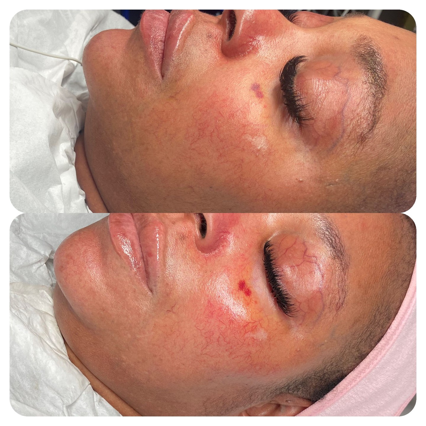 What if your skin could truly glow?
Meet one of our lovely clients who said, “My skin never felt this good!” after her advanced facial at Beauty by Naz. She came in feeling self-conscious about dullness, but left with a radiant, even complexion and a newfound confidence.
Every transformation is unique. I take the time to understand your skin goals, so you can feel amazing in your own skin.
Ready for your own before and after moment? Book your transformation with Naz today. ✨