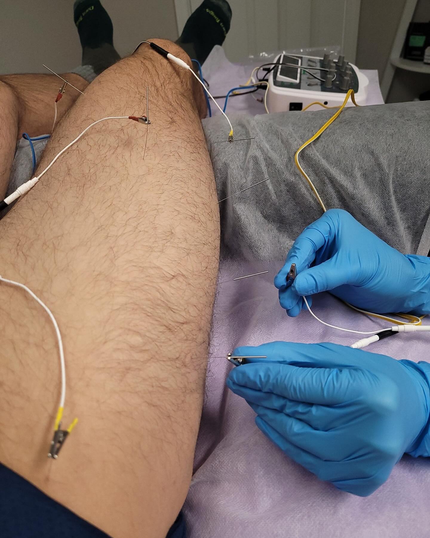 ⚡️Boost Your Sports Recovery with Electroacupuncture ⚡️
At Moment Wellness Acupuncture in Conifer, Colorado, electrostimulation acupuncture helps athletes recover faster by reducing muscle soreness, improving circulation, and supporting injury healing. Whether you’re training hard or staying active, this advanced acupuncture technique can help you get back to doing what you love—stronger and sooner. 🏃♂️💪
#Electroacupuncture #SportsRecovery #AcupunctureJeffersonCounty #MomentWellness #AthleteRecovery #MuscleRecovery #NaturalHealing #EvergreenCO #BaileyCO #ConiferCO #PineCO