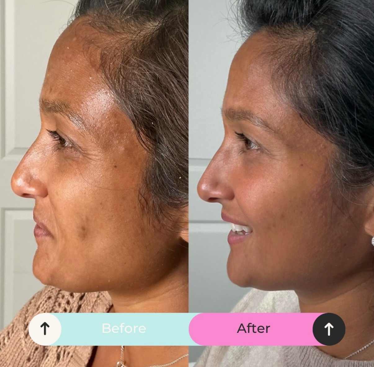 The magic of your own product 🩸
Vampire facials giving all the glow using platelet rich plasma from your own blood with a side of microneedling giving your skin the goodness it’s been begging for ✨