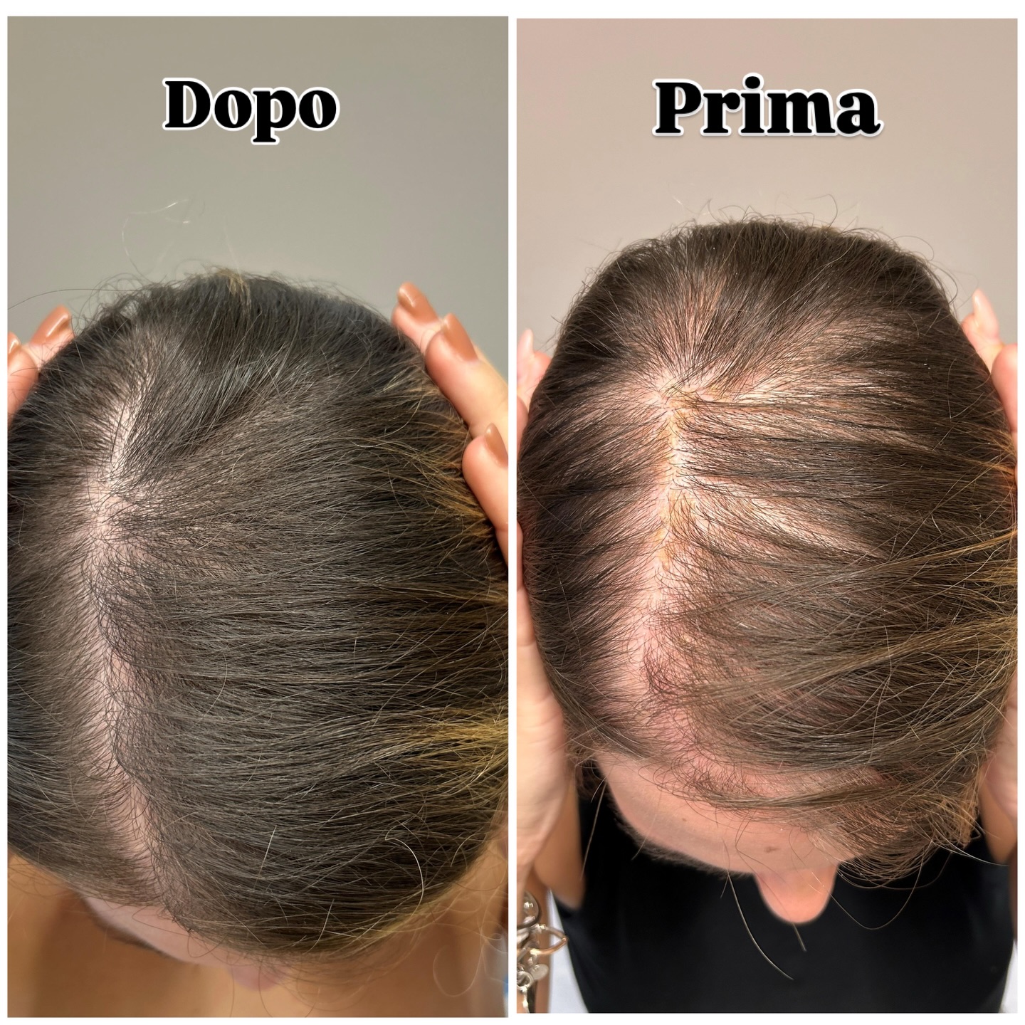 ✨ Caduta dei capelli: quando la diagnosi fa la differenza ✨
Queste immagini mostrano un prima e dopo reale, ottenuto grazie a una terapia dermatologica personalizzata, basata su una diagnosi accurata del tipo di alopecia.
🔍 La caduta dei capelli non è mai uguale per tutti: può dipendere da fattori ormonali, infiammatori, genetici, carenziali o dallo stress.
Per questo il primo passo non è “un prodotto”, ma una valutazione tricologica specialistica.
💉🧴 In questo caso, un trattamento mirato ha permesso di:
✔️ ridurre la caduta
✔️ stimolare la ricrescita
✔️ migliorare densità e qualità del capello
📌 I risultati richiedono tempo, costanza e terapie corrette, ma quando il trattamento è giusto, i capelli rispondono.
👉 Se noti un aumento della caduta o un diradamento progressivo, non aspettare: intervenire precocemente è fondamentale. #tricologia #cadutadeicapelli #alopecia #dermatologia #primadopo hairloss dermatologoricrescita